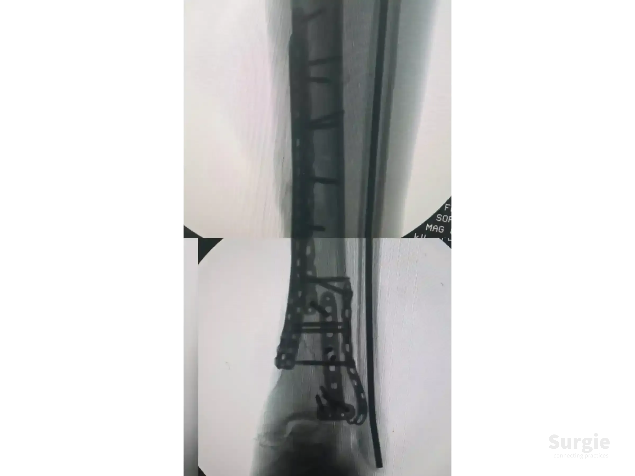 X-ray showing a tibial pilon fracture repaired with metallic plates and screws using anterolateral and medial approaches.