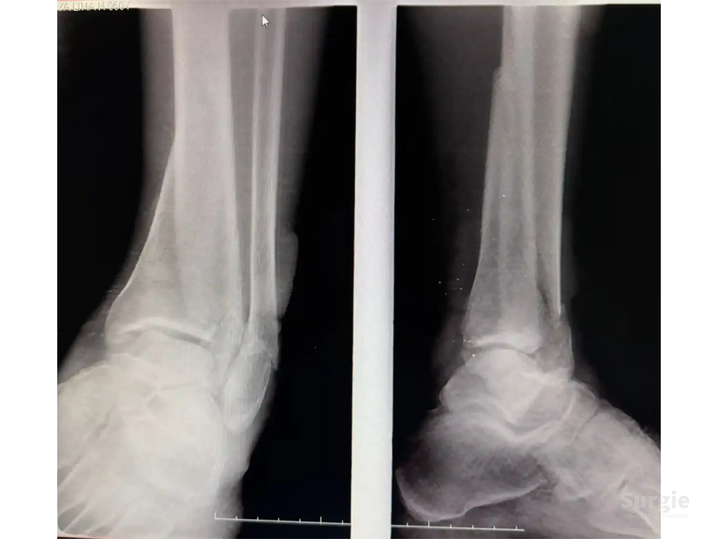 Anteroposterior and lateral X-ray views showing a complex tibial pilon fracture of the ankle joint.
