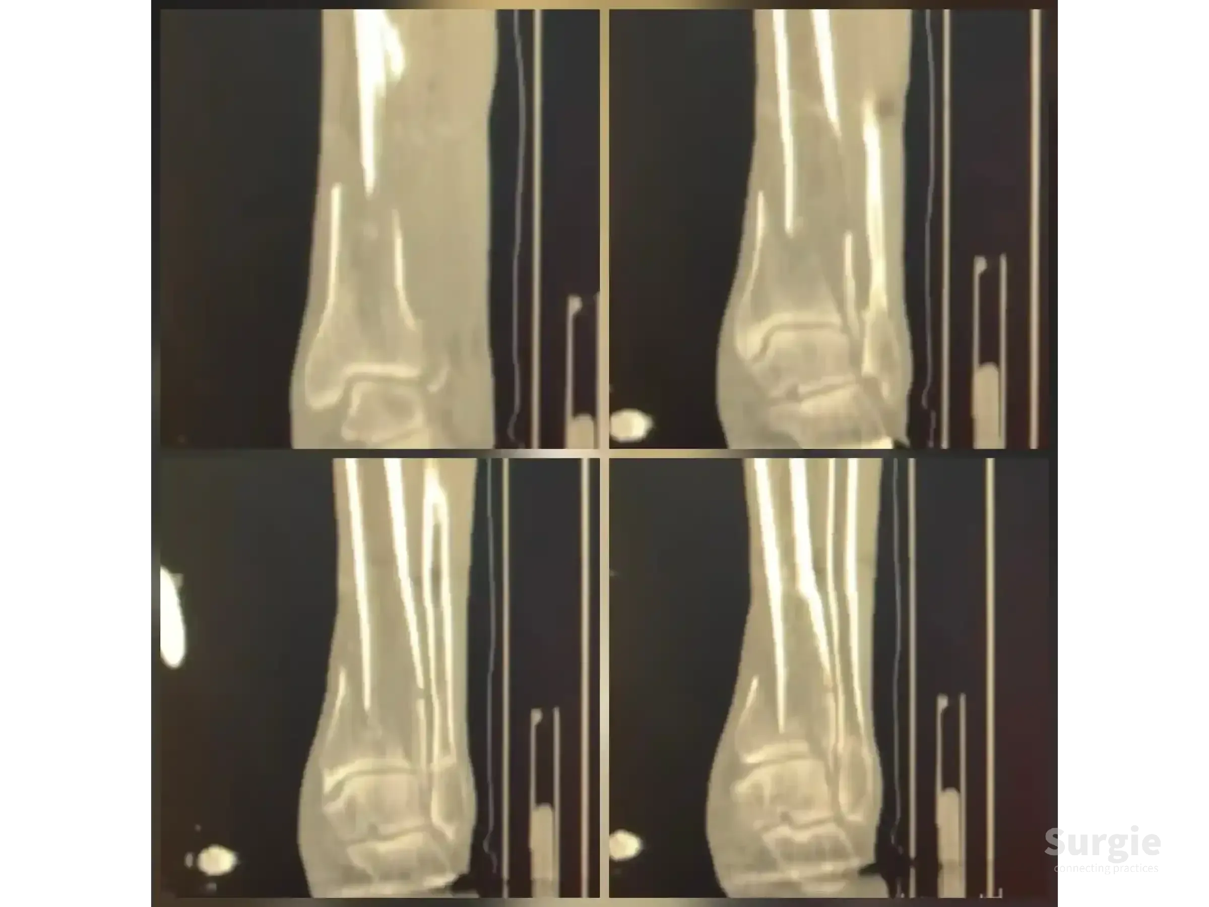 Four-panel CT scan showing a complex tibial pilon fracture with displaced fragments in the ankle region.