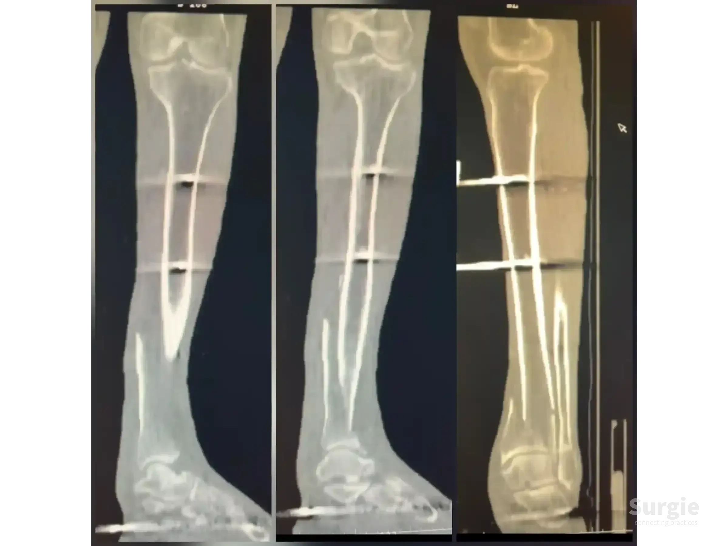 CT scan showing a tibial pilon fracture with external fixation pins and a displaced anterolateral fragment.