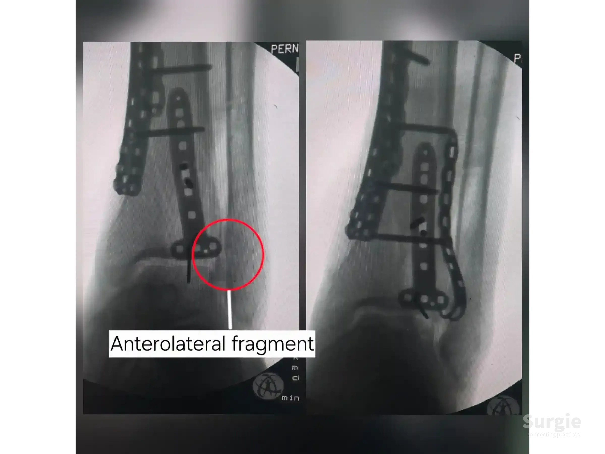 X-ray showing tibial pilon fracture fixation with metal plates and screws, highlighting the displaced anterolateral fragment.