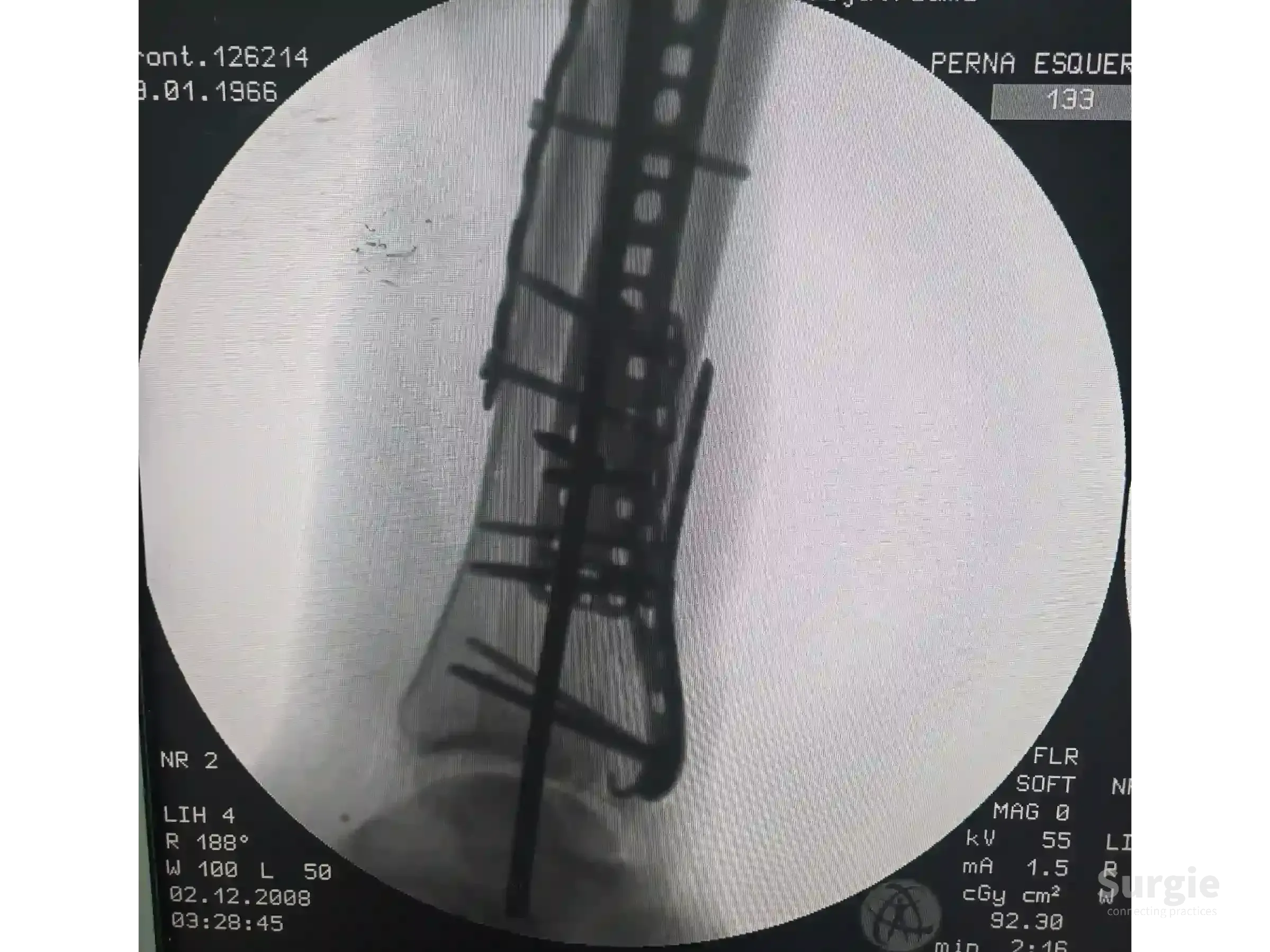 X-ray showing a tibial pilon fracture stabilized with a metal plate and screws along the distal tibia.