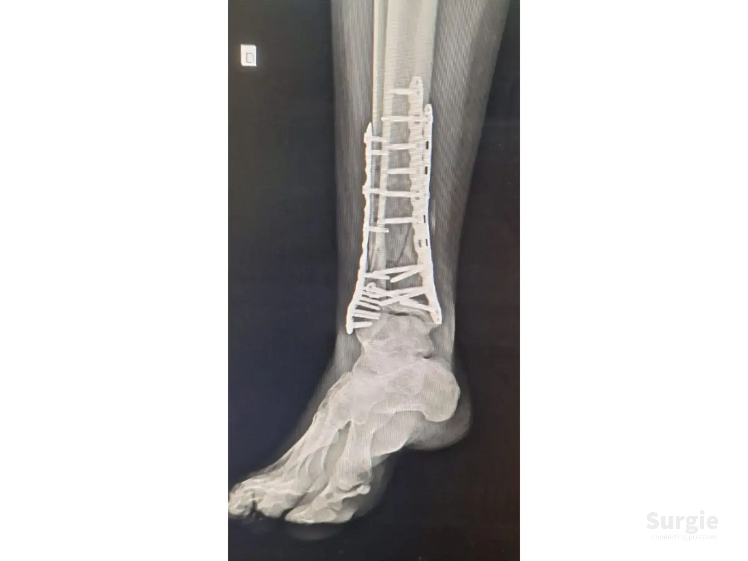 X-ray of a tibial pilon fracture repaired with a titanium plate and multiple surgical screws on the distal tibia.