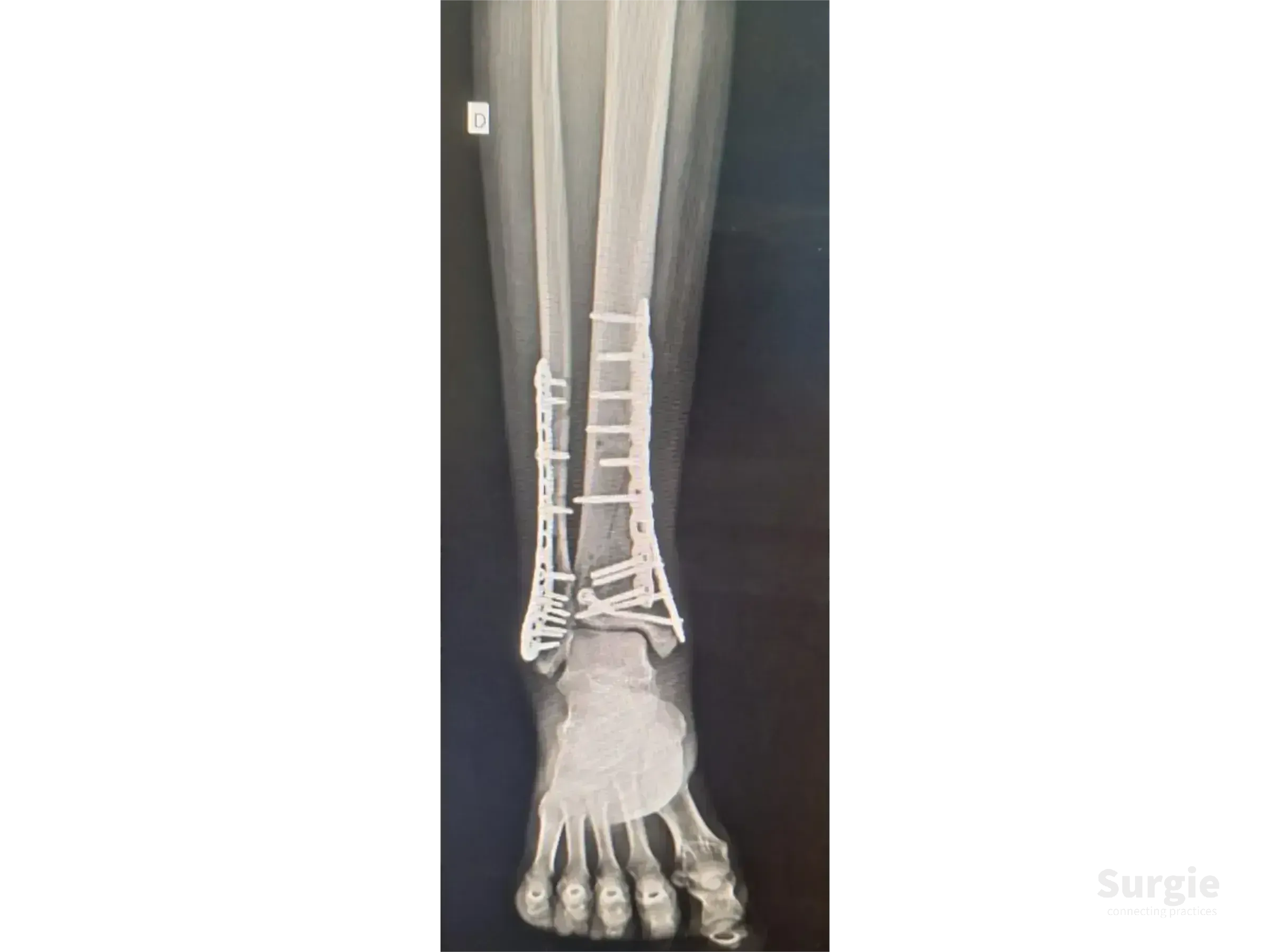 X-ray showing a tibial pilon fracture repaired with titanium plates and screws on the distal tibia and fibula.