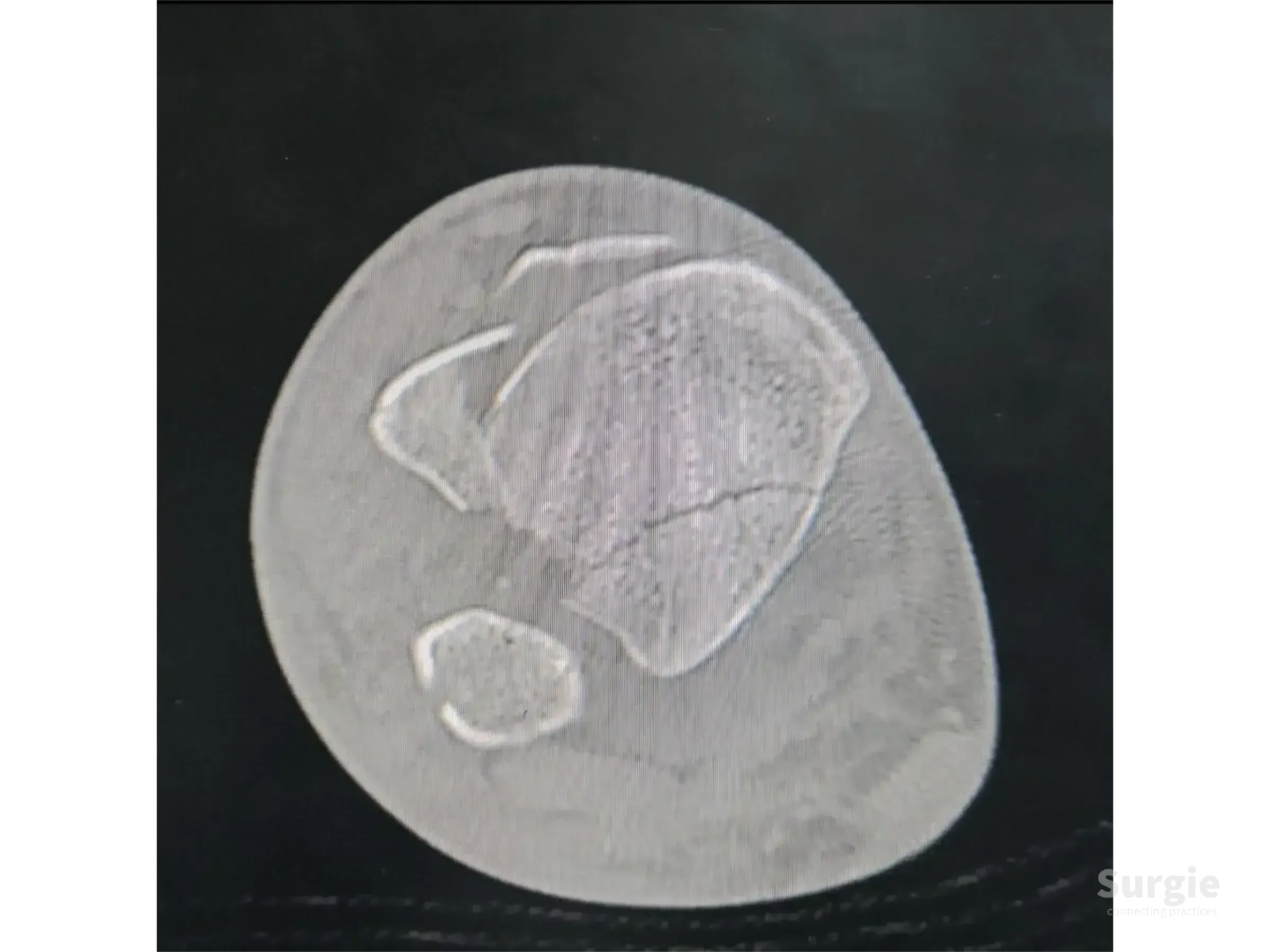 Axial CT scan showing a complex tibial pilon fracture with multiple bone fragments on a black background.