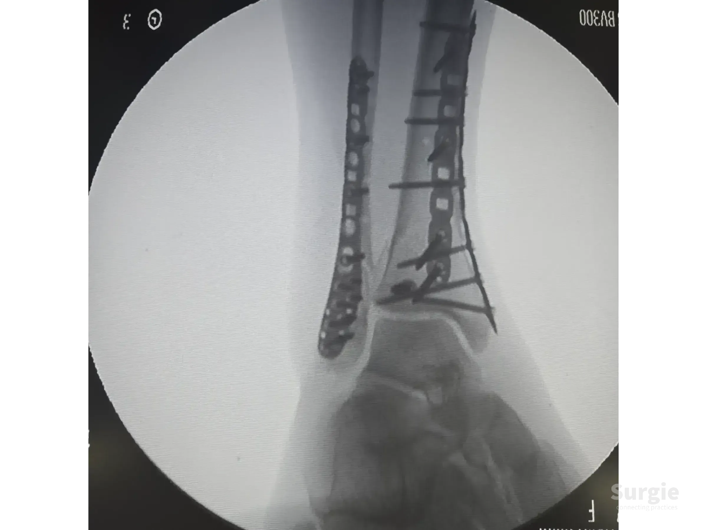 X-ray showing a tibial pilon fracture repaired with titanium plates and screws on the distal tibia and fibula.