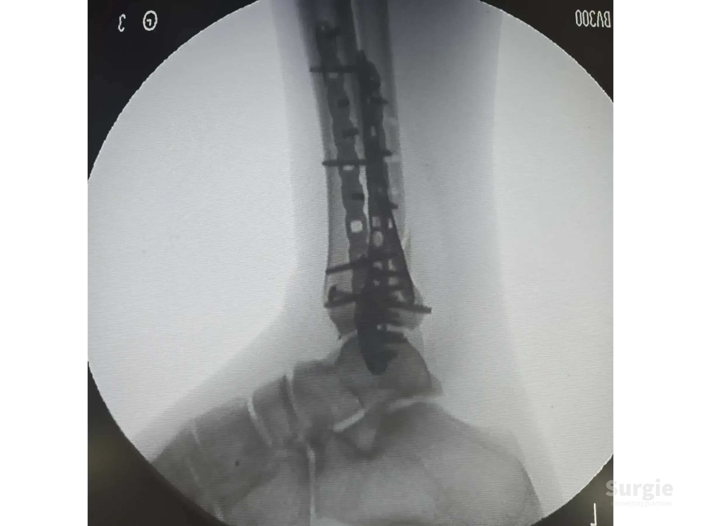 X-ray showing titanium plates and screws fixating a complex tibial pilon fracture with anatomical joint restoration.