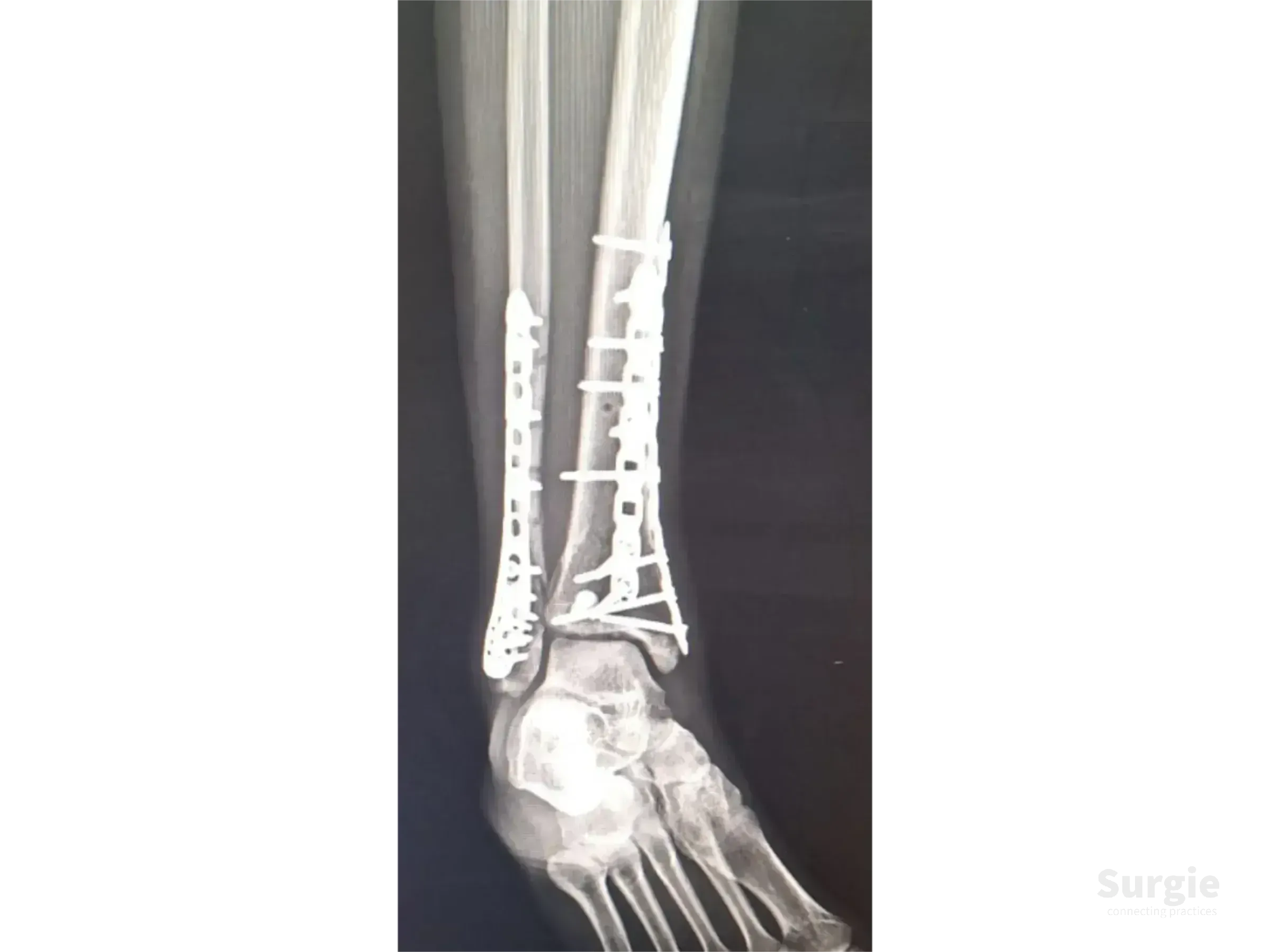 X-ray showing a tibial pilon fracture repaired with titanium plates and screws on the distal tibia and fibula.