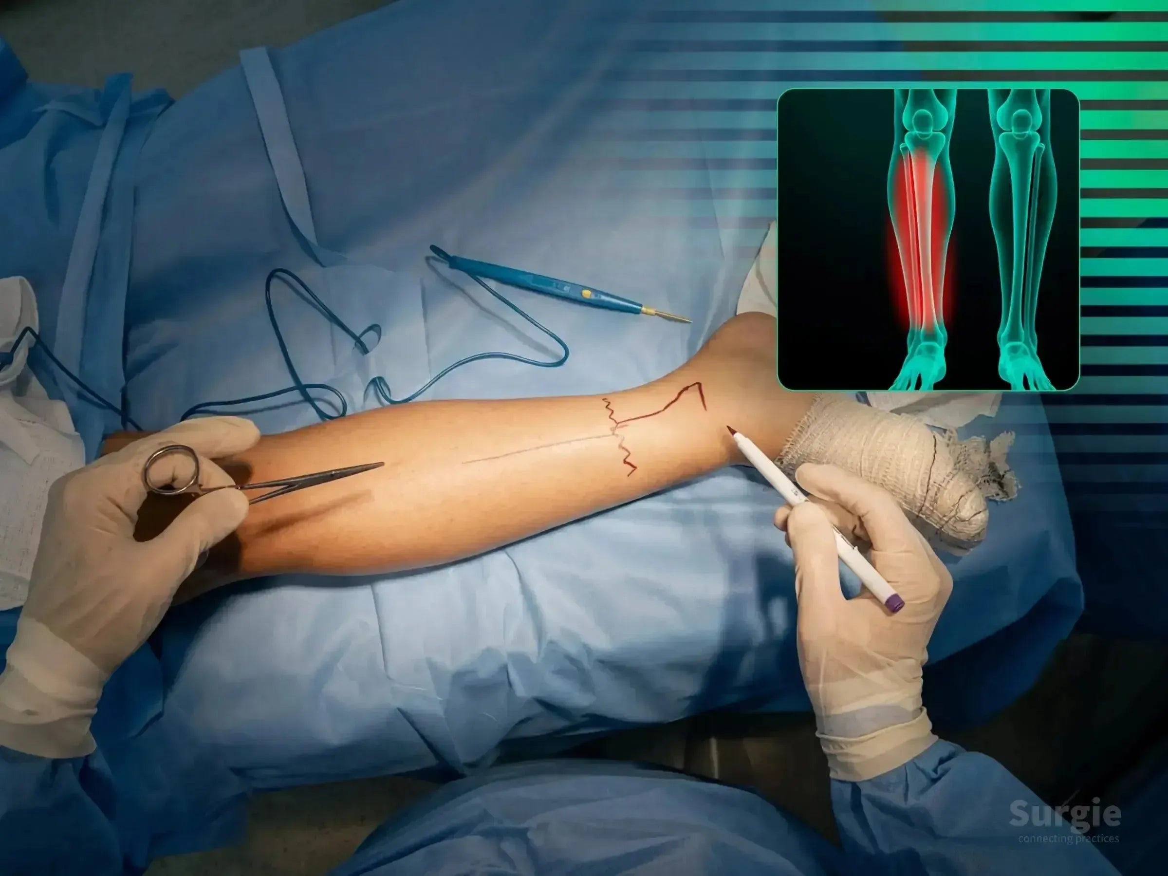 Surgeon marking a patient's leg for tibial pilon surgery with a digital X-ray overlay showing a fracture.