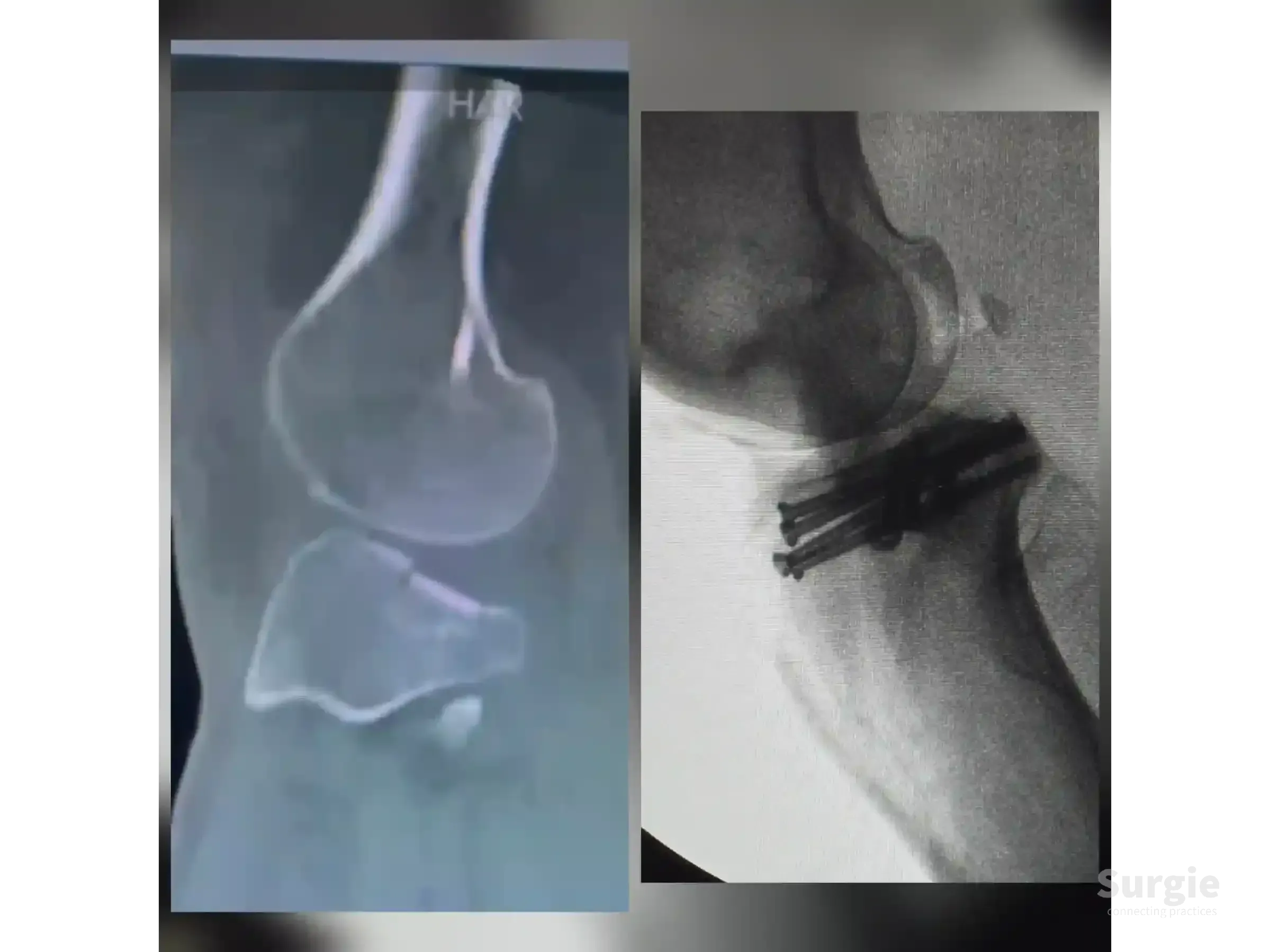 Lateral knee X-ray showing a tibial plateau fracture before and after surgical fixation with subchondral screws.