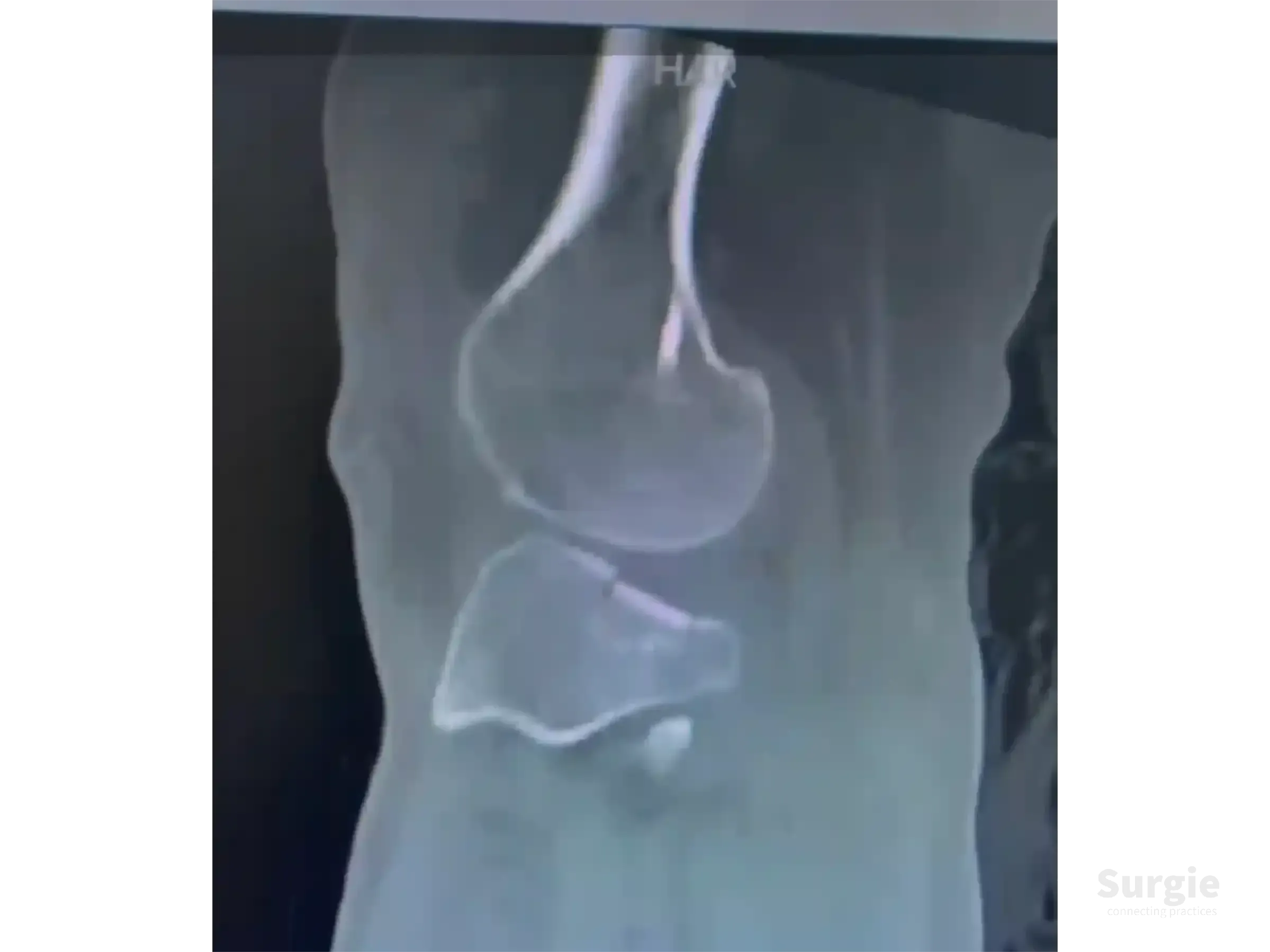 Grayscale CT scan showing a posterolateral tibial plateau depression fracture of the knee joint.