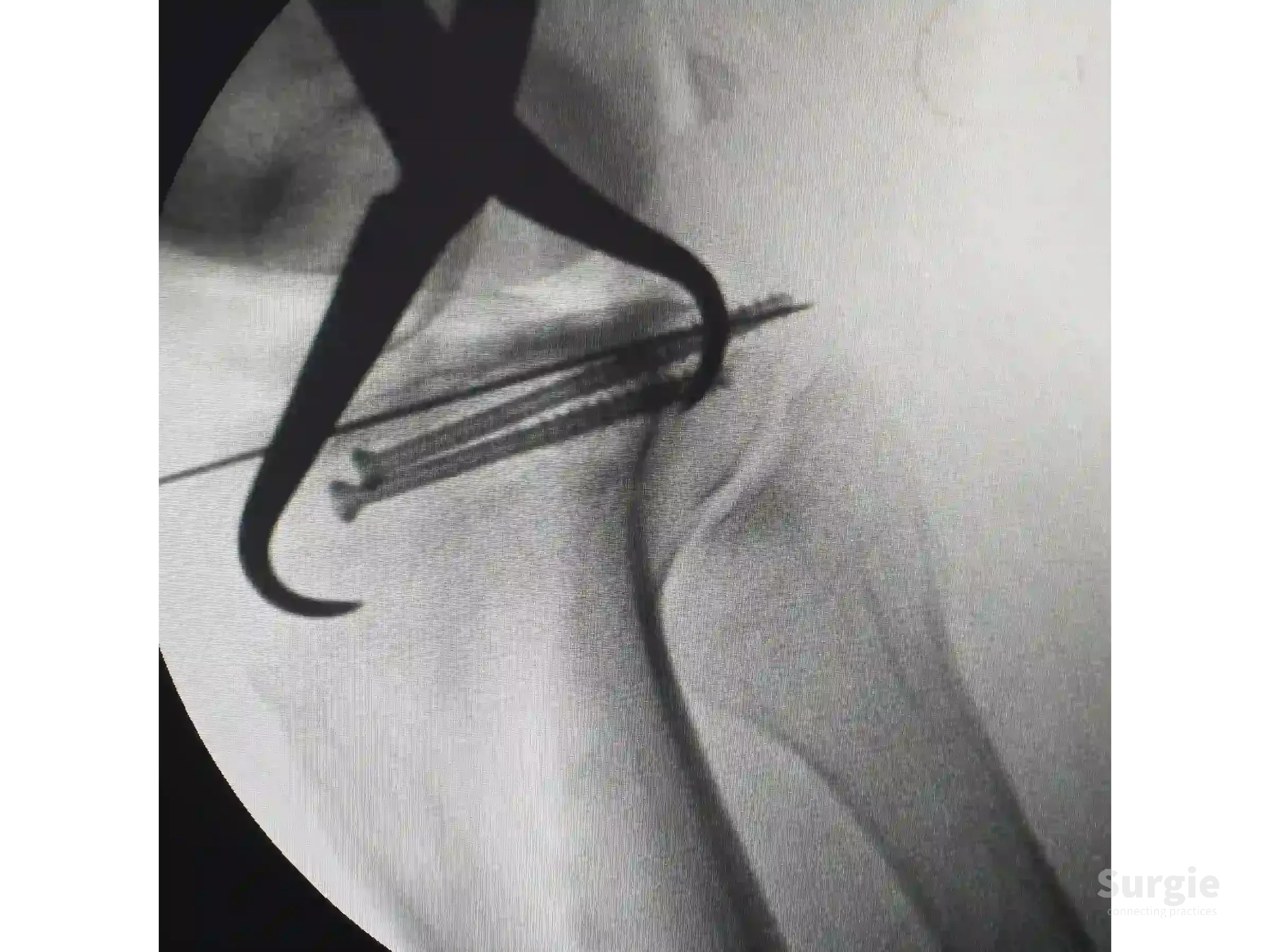 Fluoroscopic view of a tibial plateau fracture reduction with bone reduction forceps and subchondral support screws.