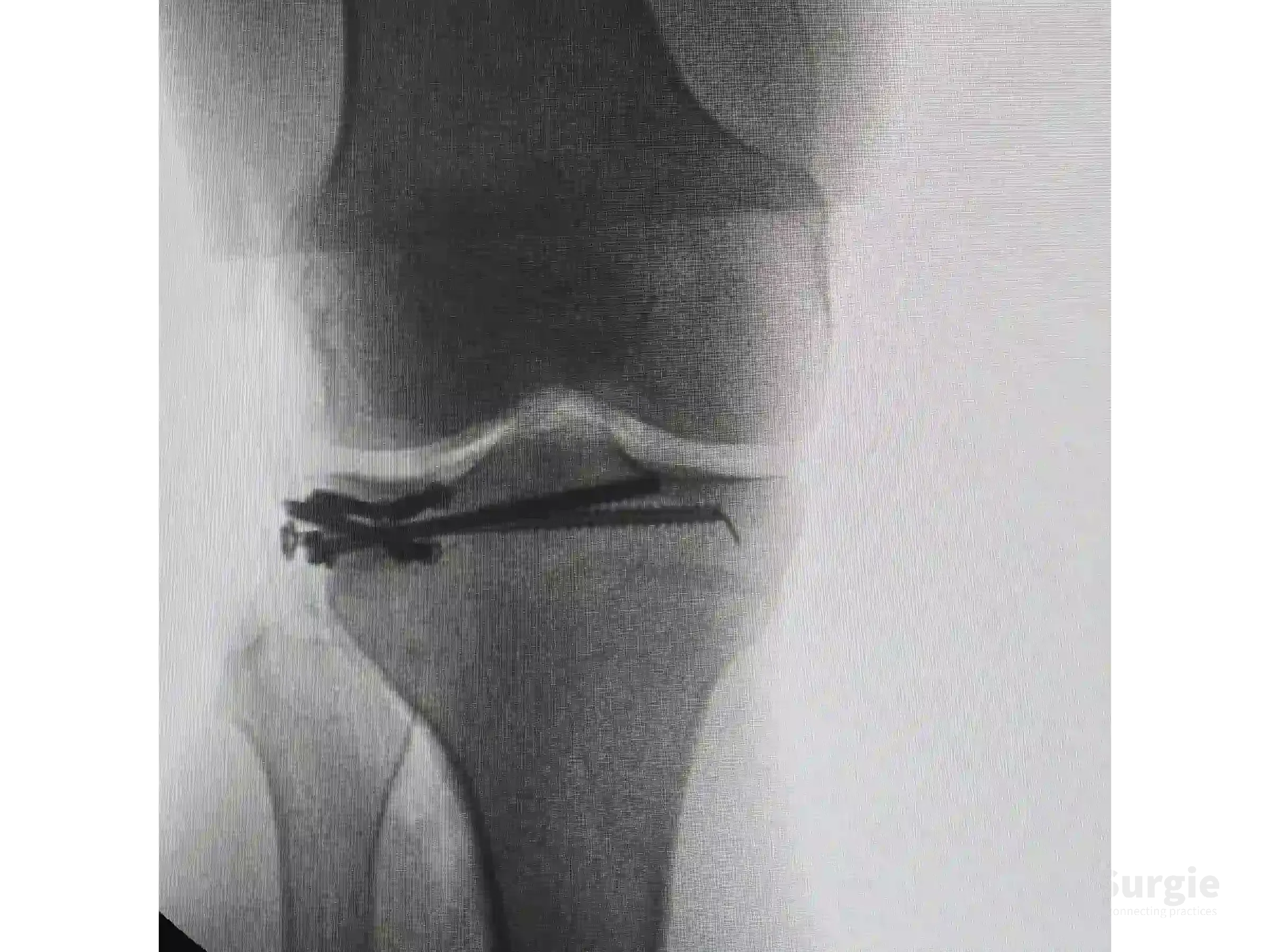Fluoroscopic X-ray of a tibial plateau fracture with subchondral support screws in a jail configuration.