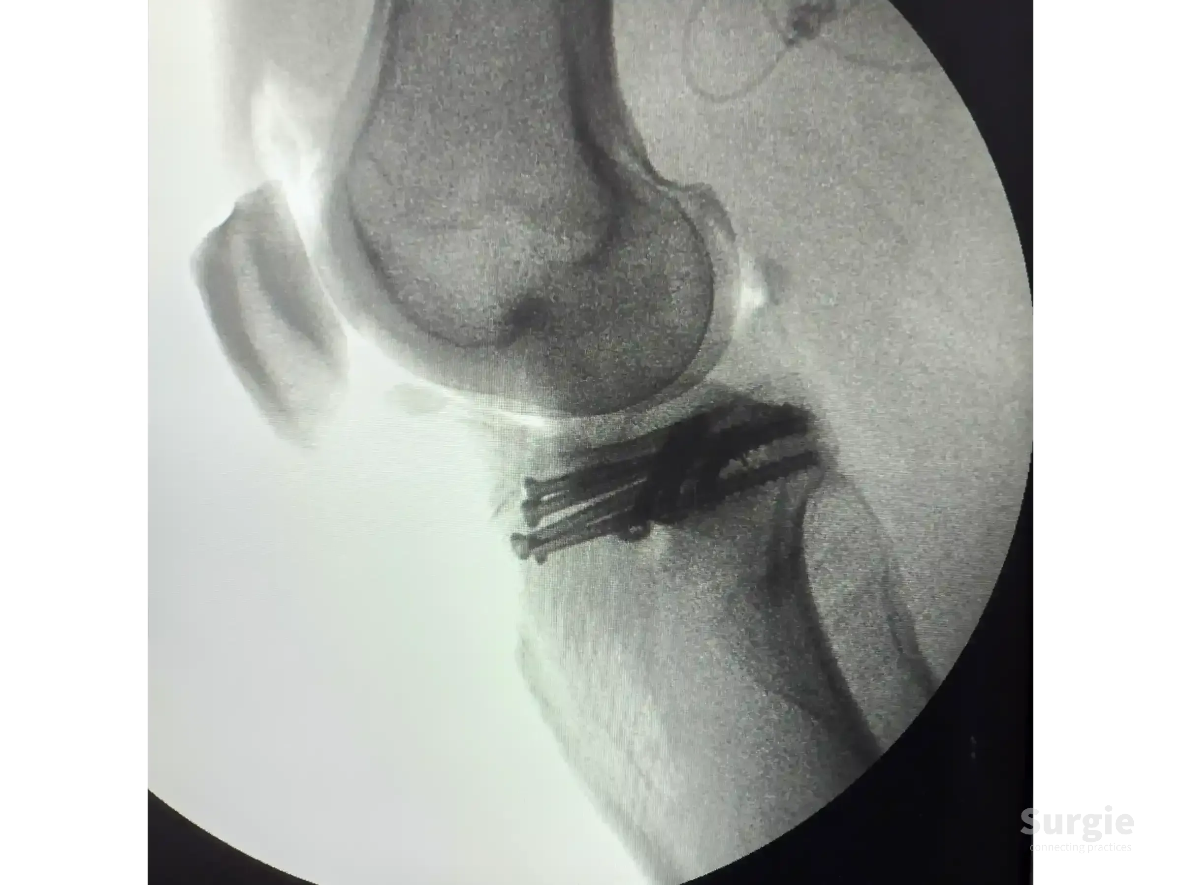 Lateral fluoroscopic X-ray of a tibial plateau fracture fixed with subchondral support screws in the knee joint.
