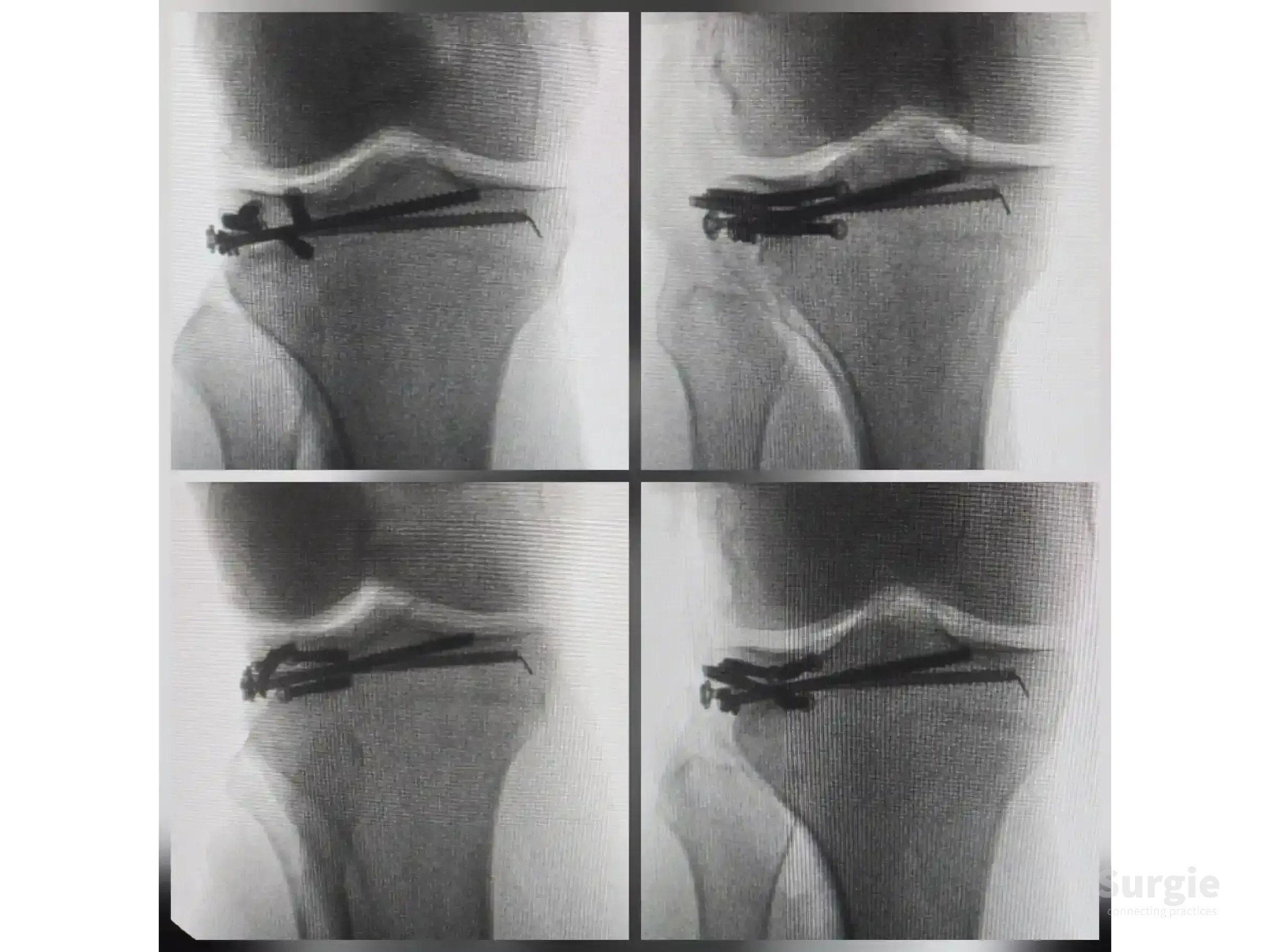 Fluoroscopic X-ray showing tibial plateau fracture reduction with subchondral support screws in a jail configuration.