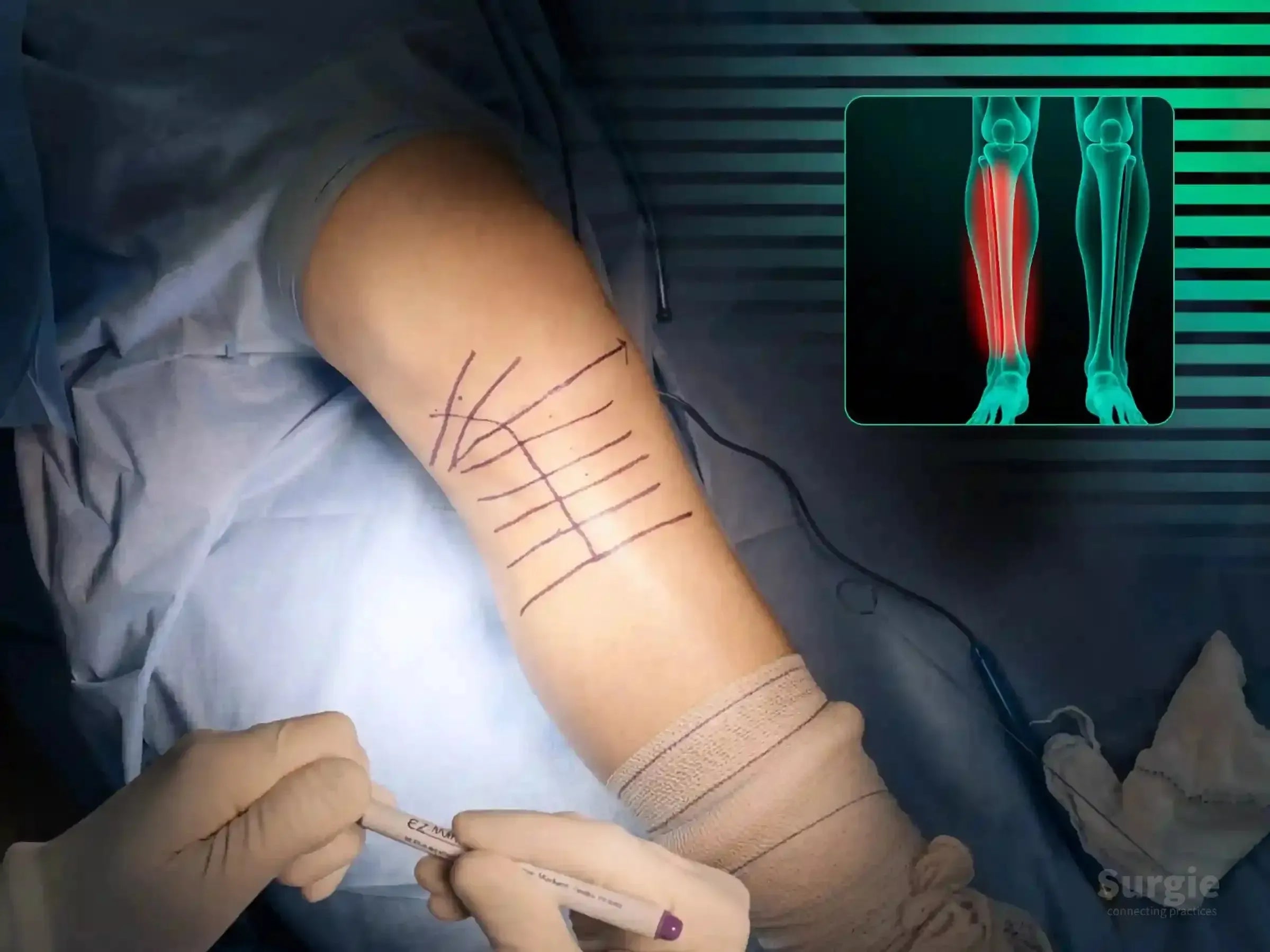 Surgical site marking on a patient's leg for tibial plateau surgery with a digital bone fracture overlay.