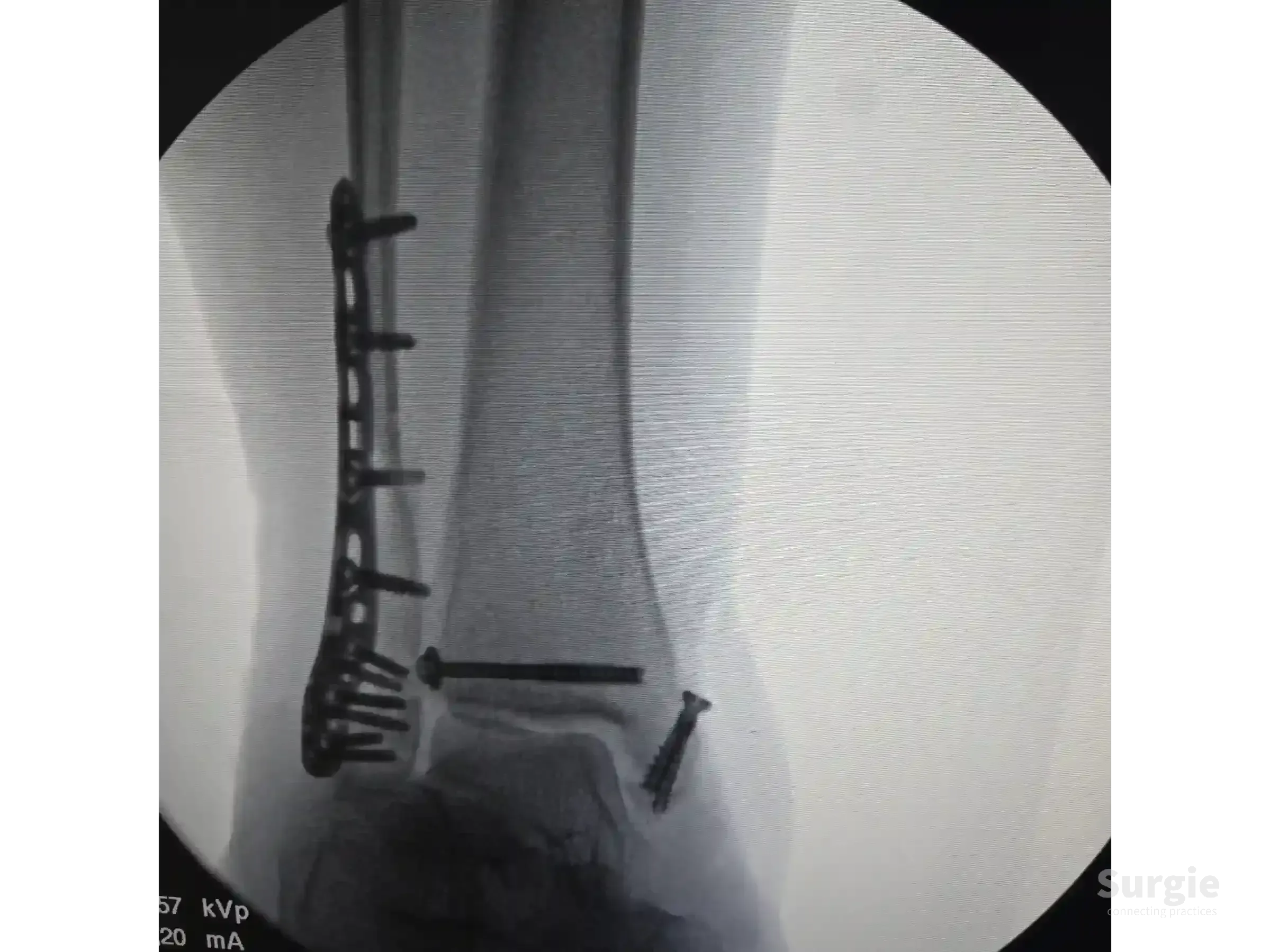 X-ray showing a trimalleolar ankle fracture fixed with a lateral plate and screws for the fibula and medial malleolus.