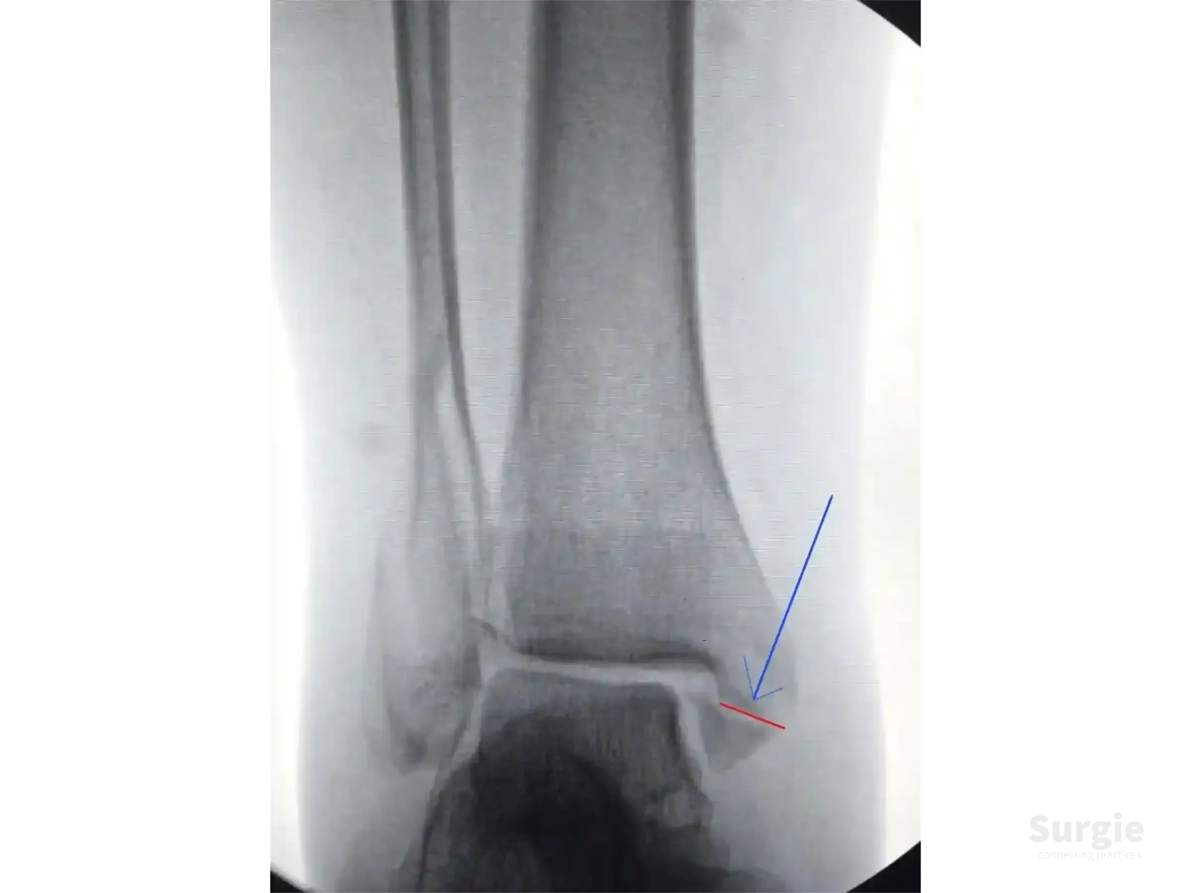 Ankle X-ray showing a medial malleolus fracture with a blue arrow and red line indicating the atypical fracture line.