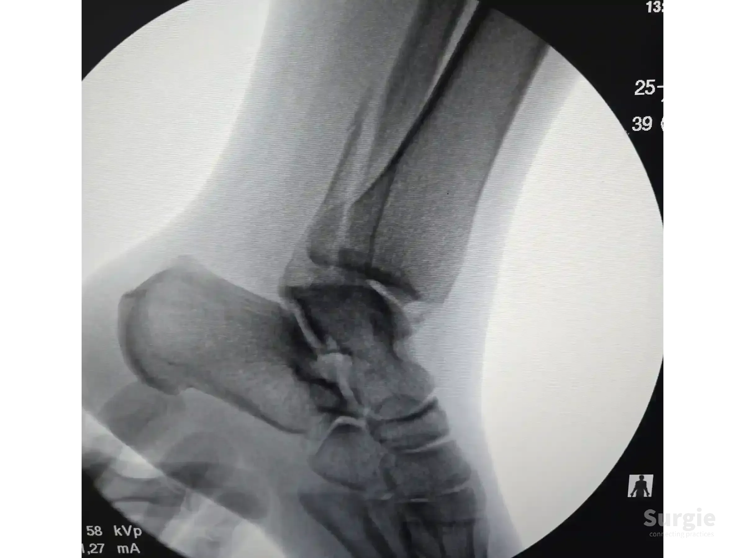 Lateral X-ray showing a trimalleolar ankle fracture with a displaced posterior malleolar fragment.