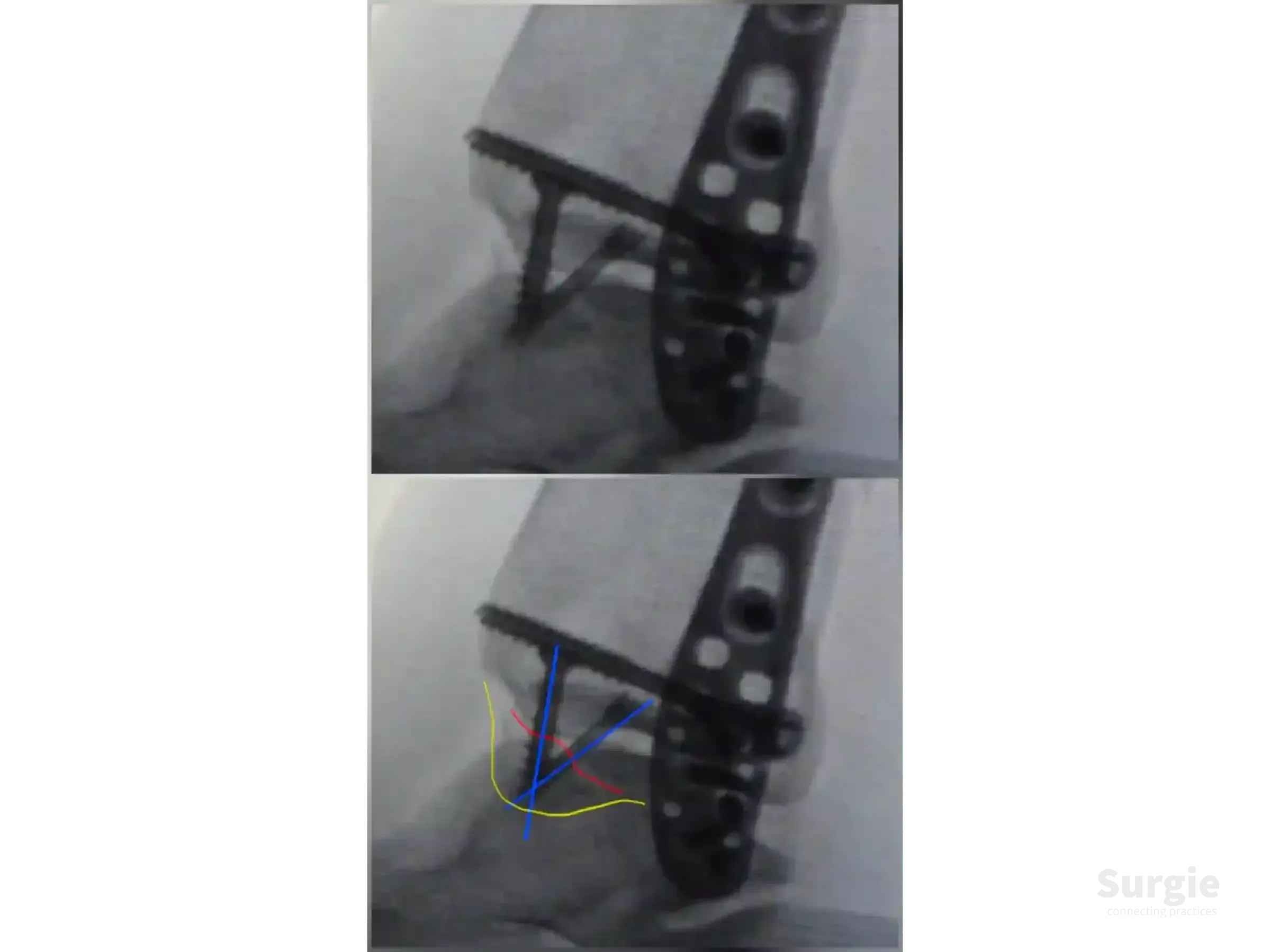 X-ray showing trimalleolar ankle fracture fixation with metal plates and screws, including anatomical overlay markings.