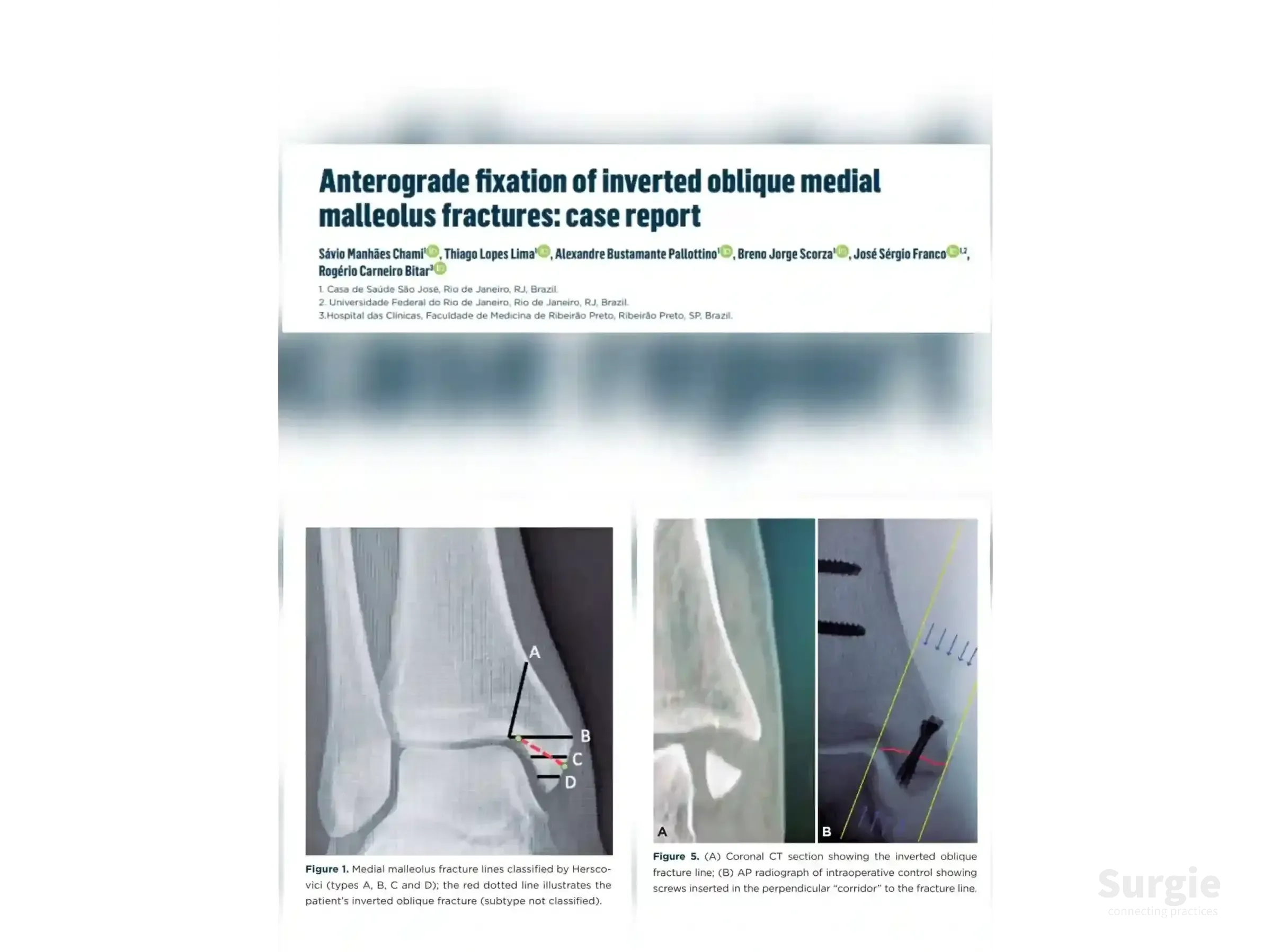 Medical case report showing ankle X-rays and CT scans of an inverted oblique medial malleolus fracture with screw fixation.