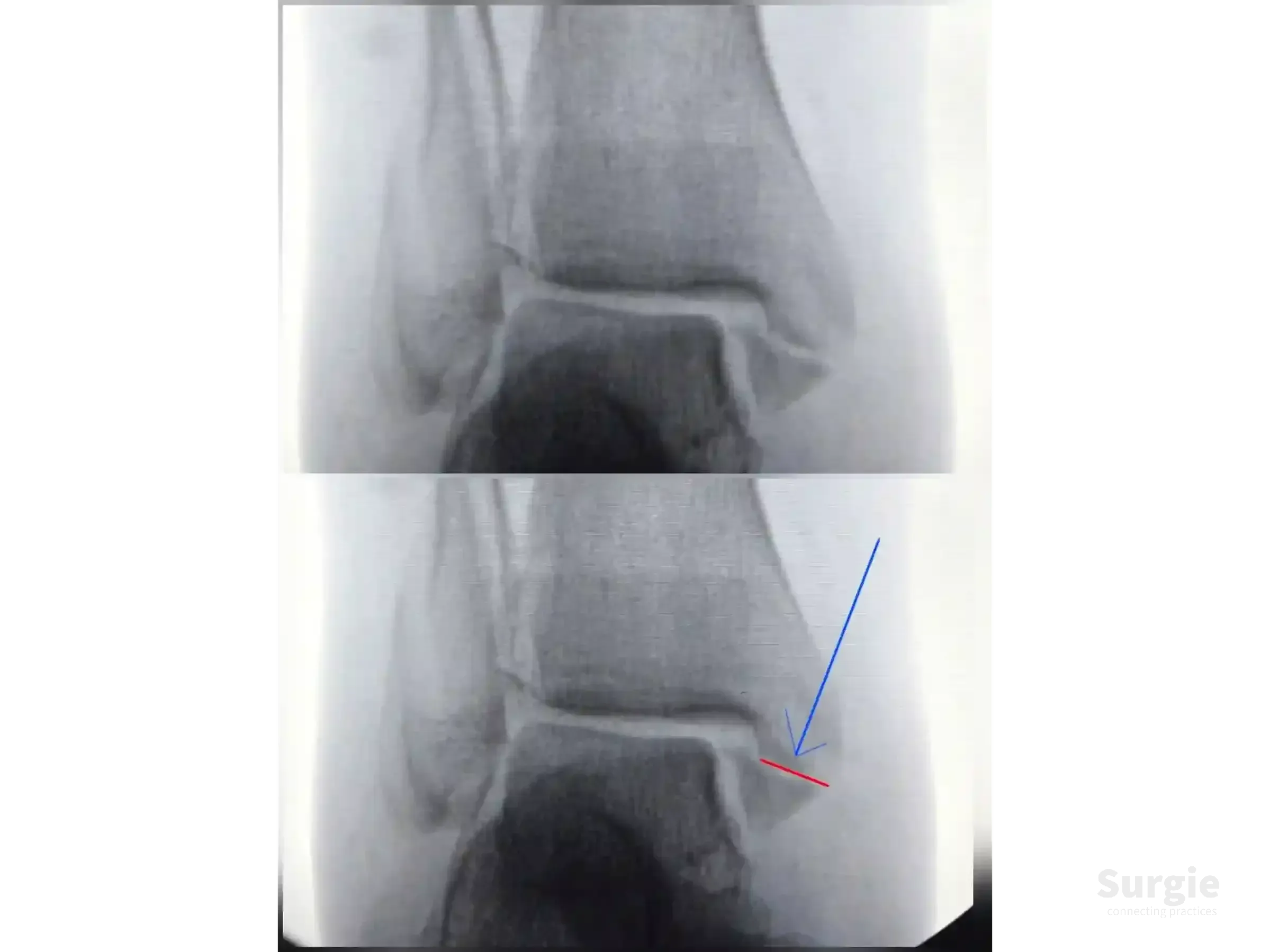 Ankle X-ray showing a medial malleolus fracture with a red line indicating the atypical oblique fracture plane.