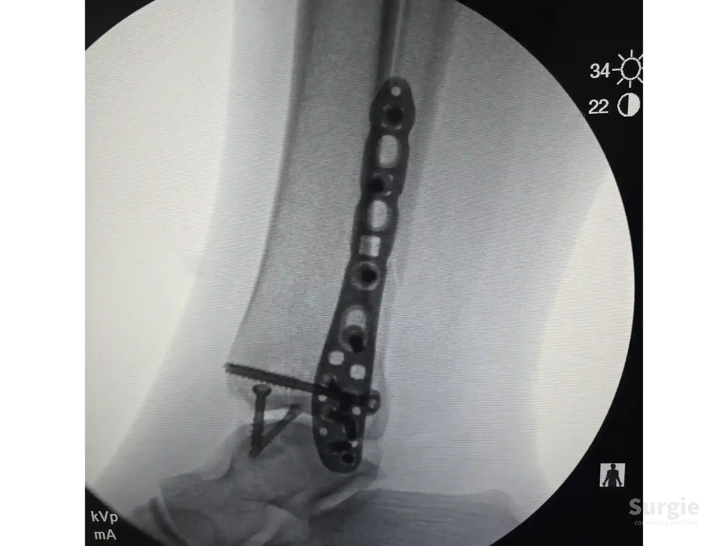 X-ray showing a metal plate and screws fixating a trimalleolar ankle fracture with an inverted medial malleolus line.