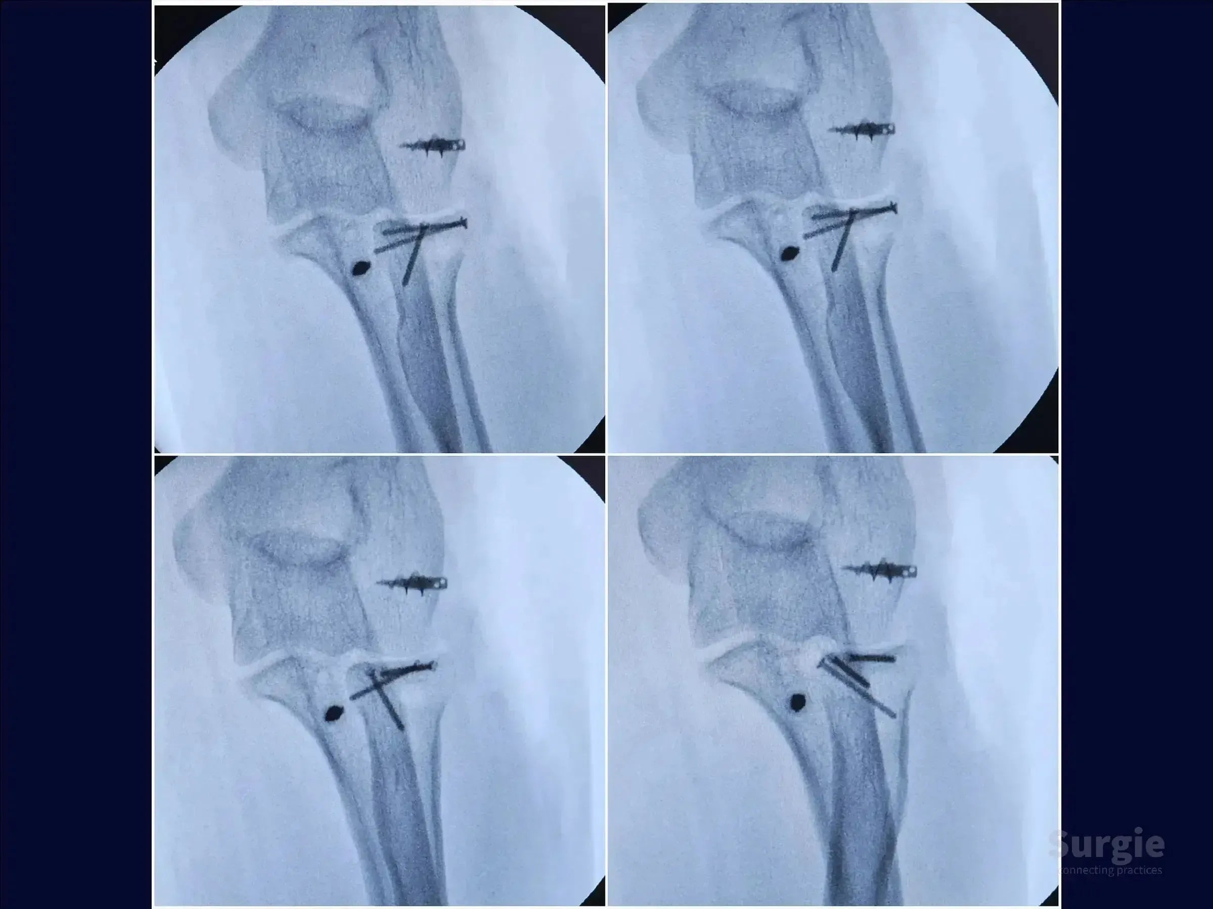 Fluoroscopic X-ray showing surgical fixation of a radial head fracture and coronoid process with metallic screws.