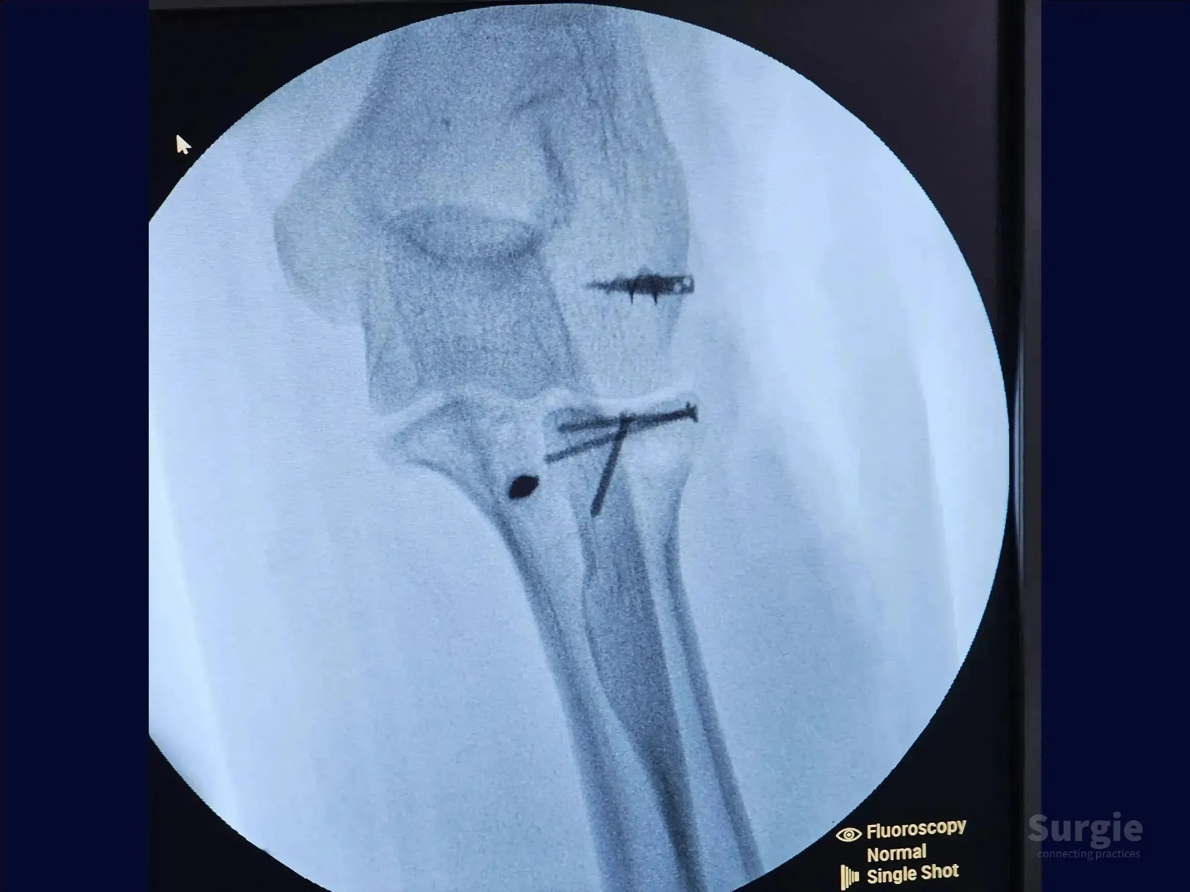 Fluoroscopic X-ray showing a reconstructed radial head fracture and coronoid process fixation with metallic screws.