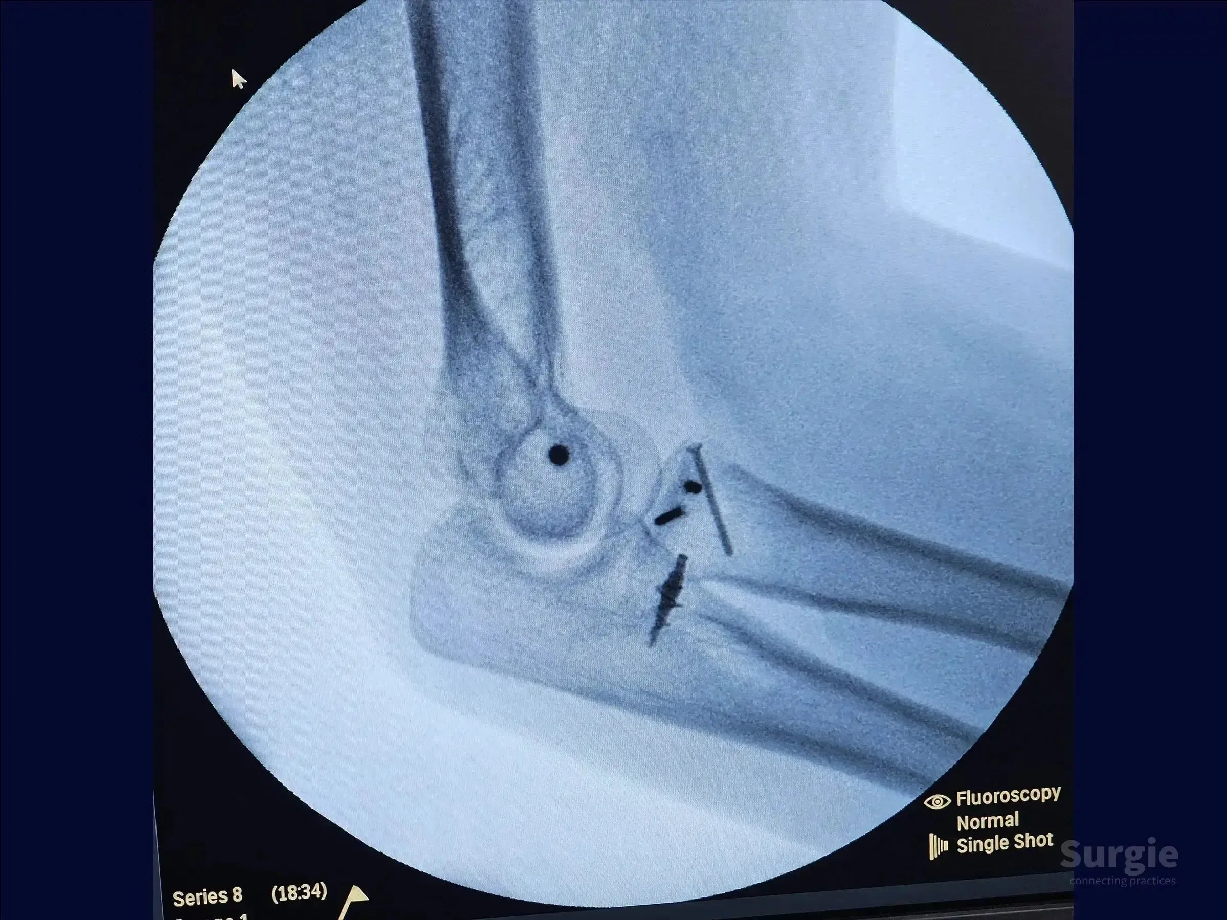 Fluoroscopic X-ray of a repaired elbow showing radial head reconstruction and metallic hardware for ligament stabilization.