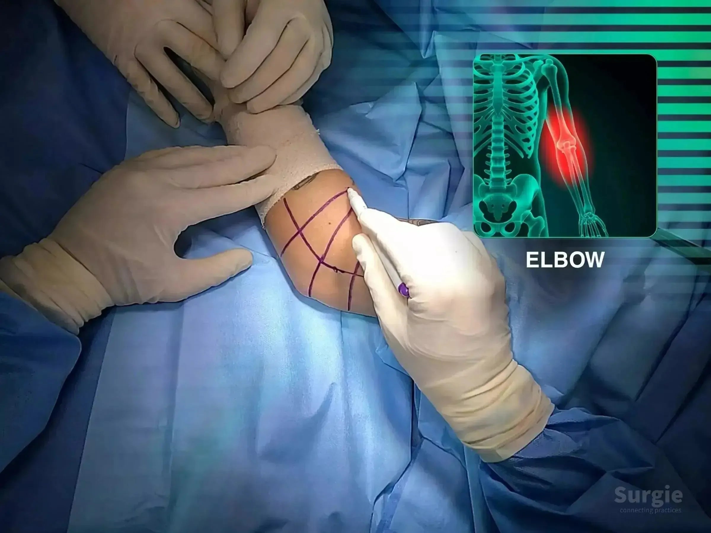 Surgeon marking an elbow for surgery with an anatomical overlay showing the joint injury on a blue surgical drape background.