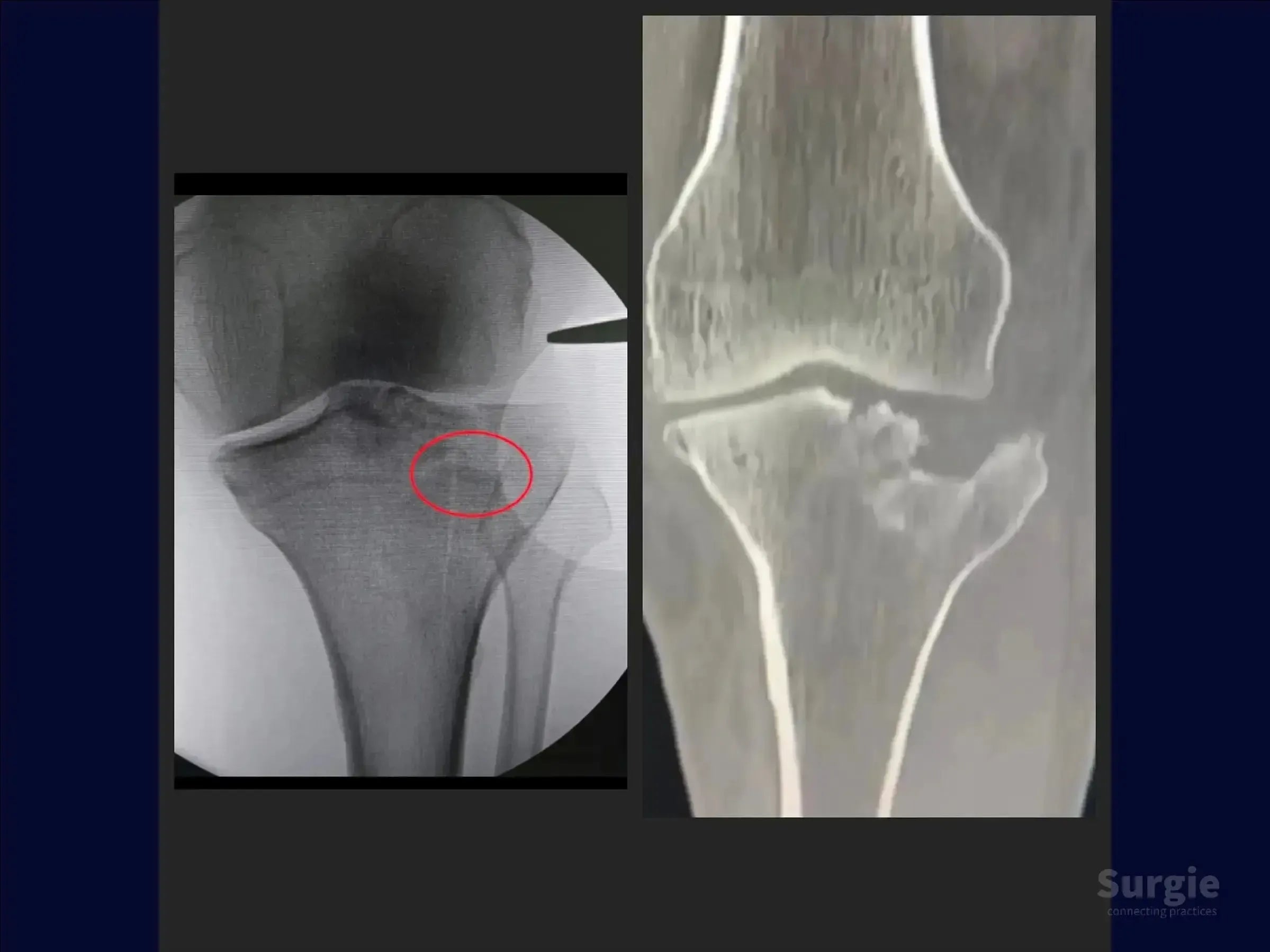 X-ray and CT scan showing a tibial plateau fracture with central depression and a red circle highlighting the injury site.
