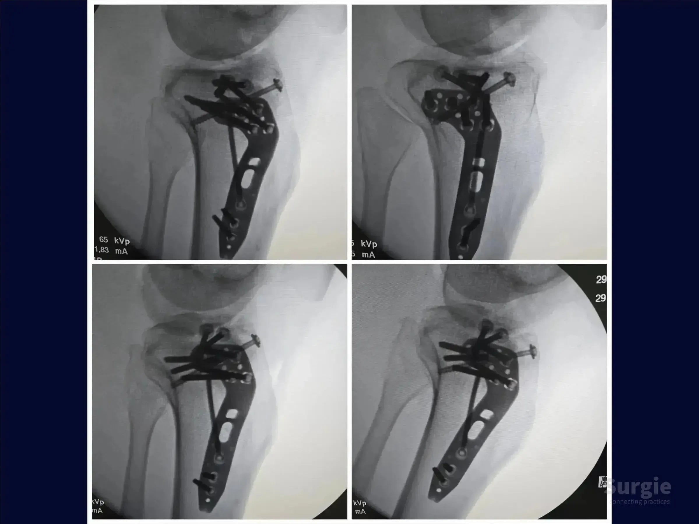Fluoroscopic X-ray showing tibial plateau fracture fixation with a metal plate and subchondral cannulated screws.