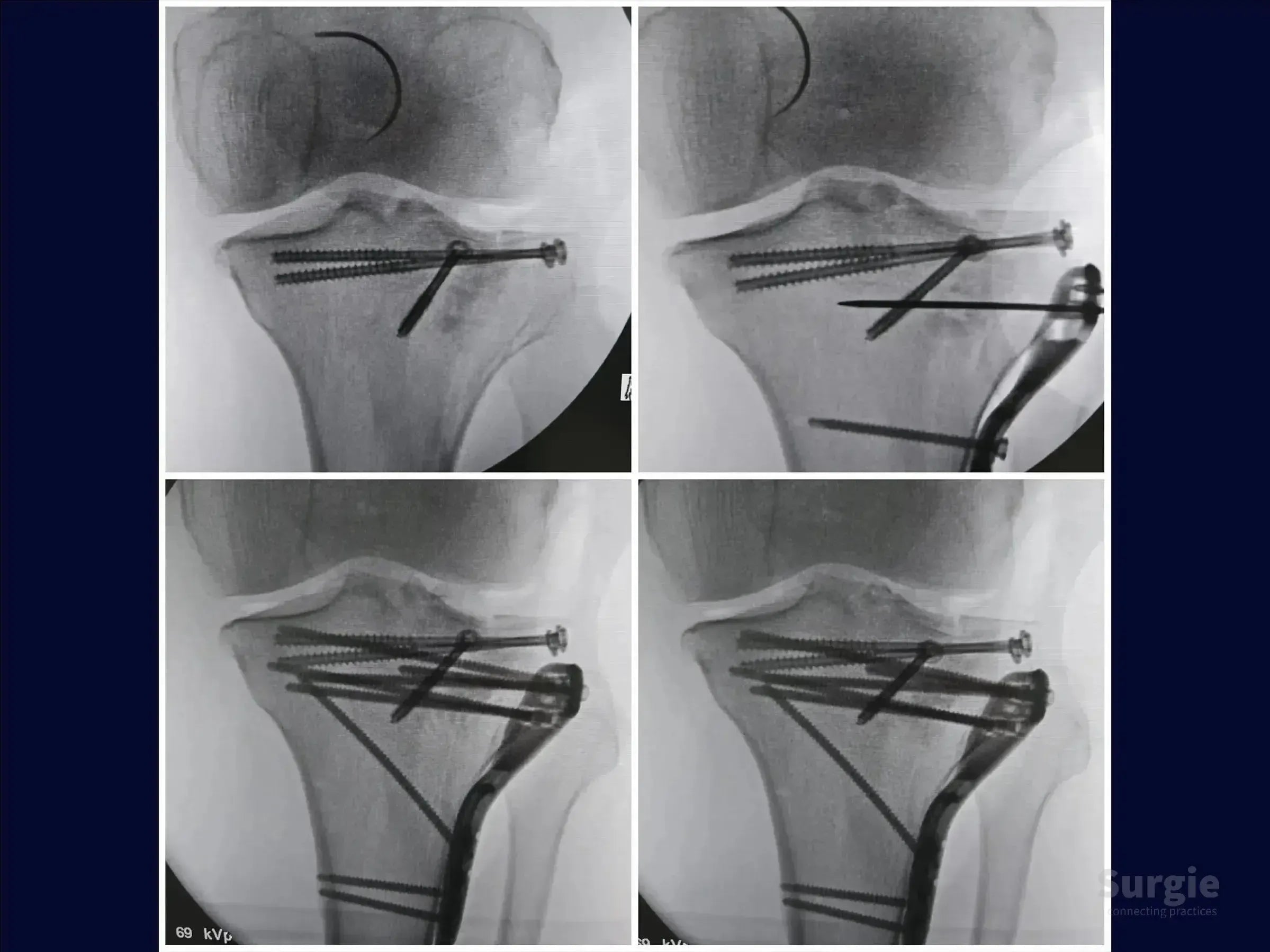 Fluoroscopic X-ray sequence showing tibial plateau fracture fixation with subchondral screws and a lateral locking plate.