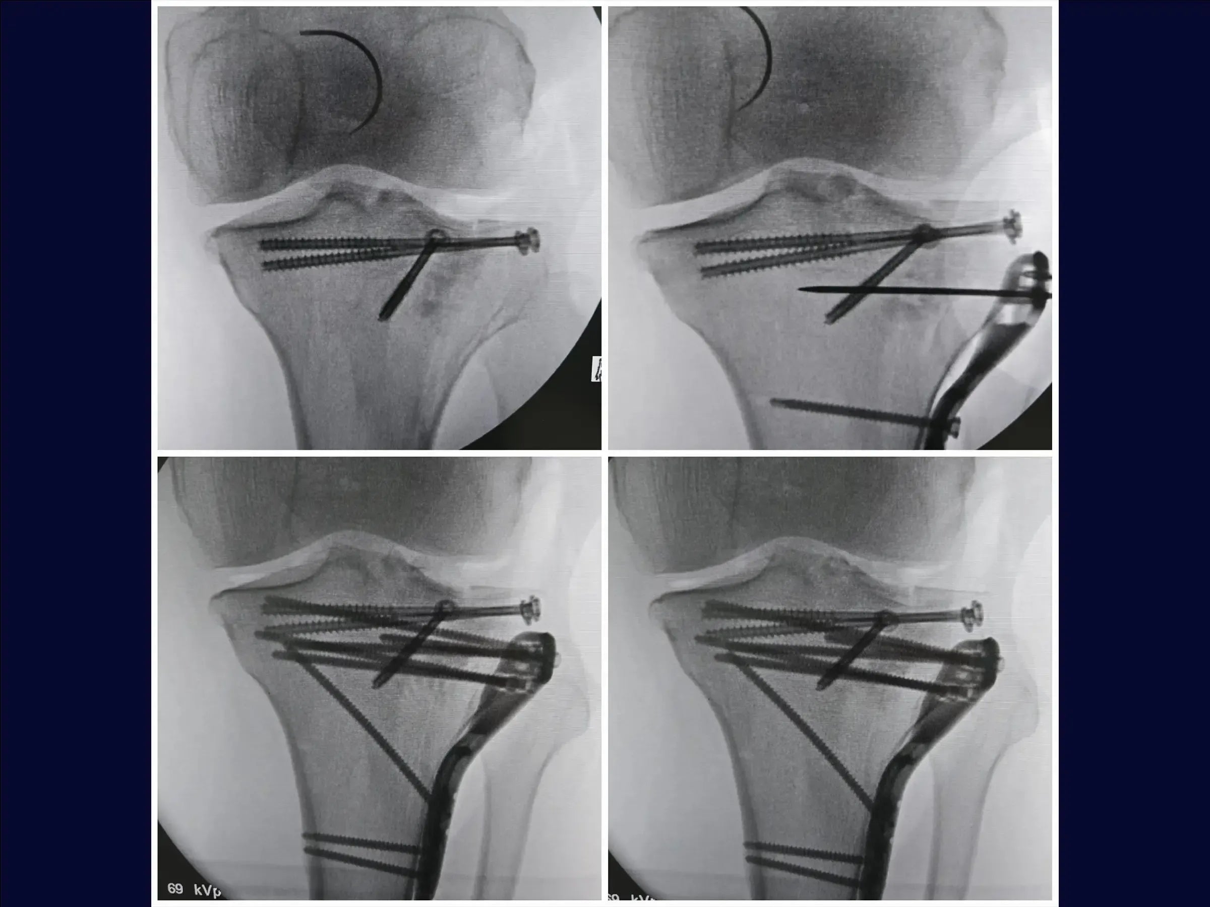 Schienbeinkopfbruch mit zentraler Impression (anterolateraler Zugang und inkomplette Osteotomie)