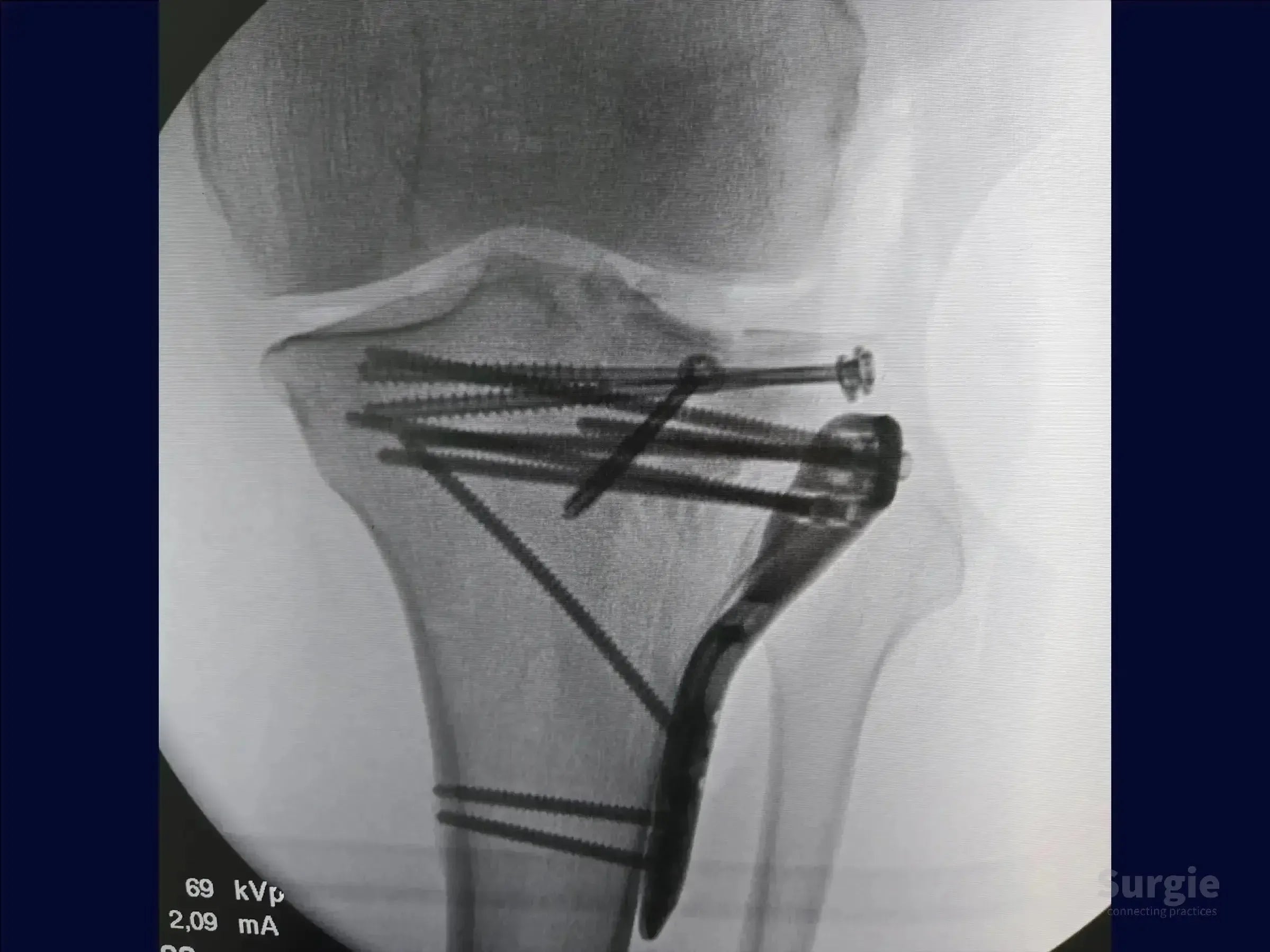 X-ray showing tibial plateau fracture fixation with a metal plate and multiple subchondral cannulated screws.