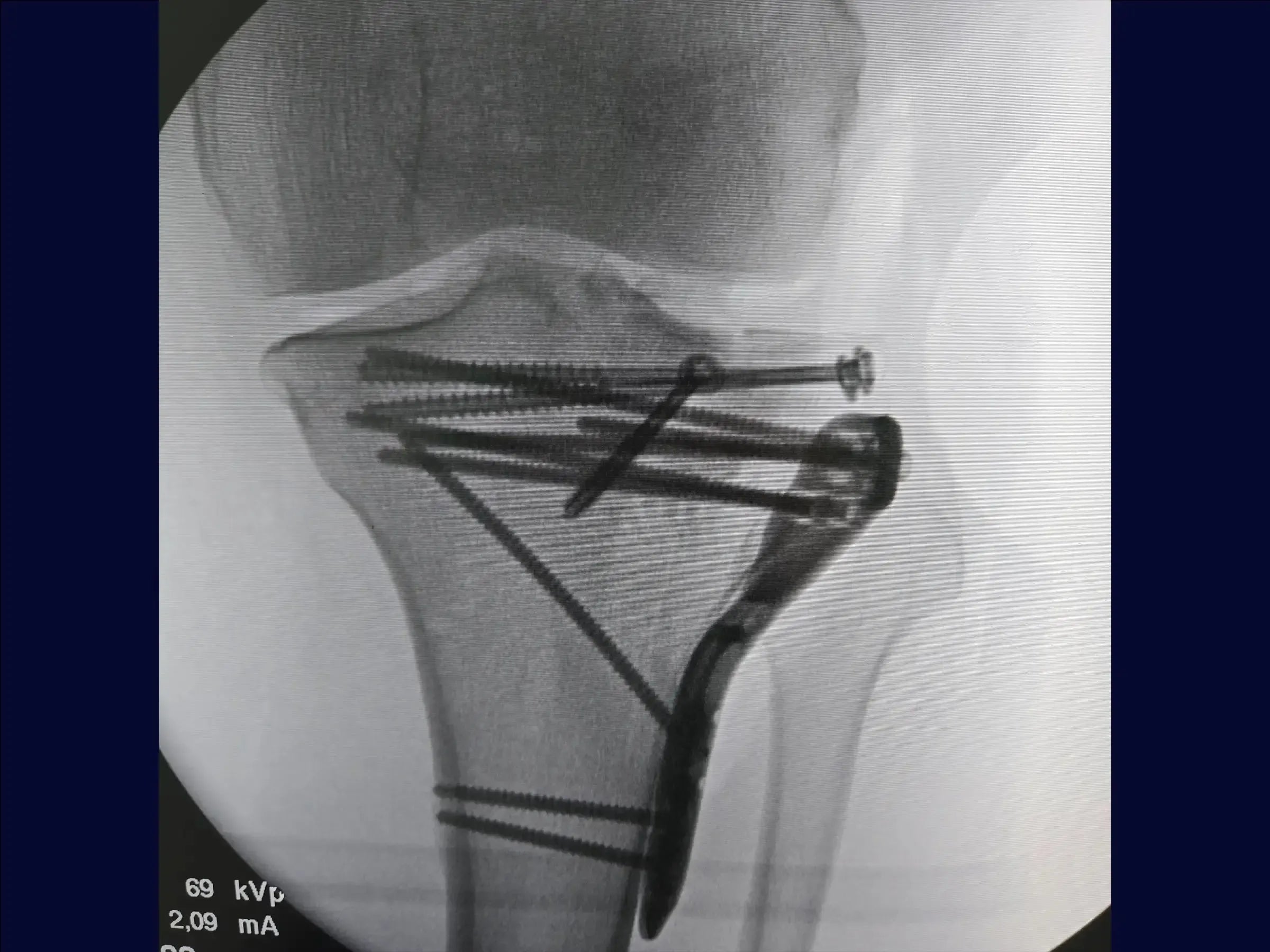 Schienbeinkopfbruch mit zentraler Impression (anterolateraler Zugang und inkomplette Osteotomie)