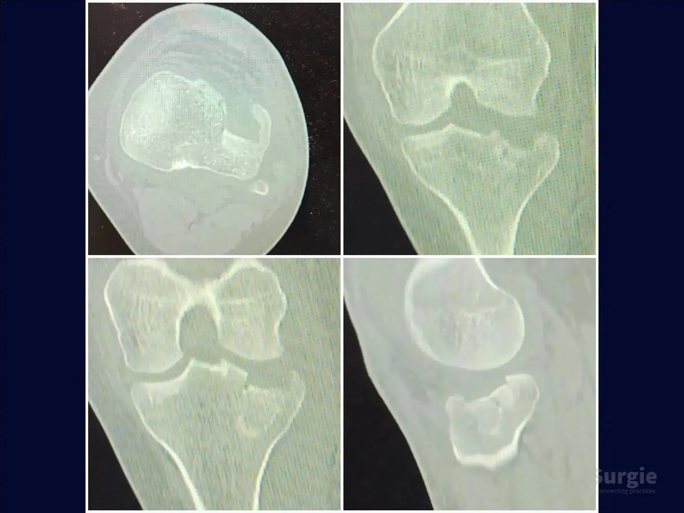 CT scan showing a tibial plateau fracture with central depression and an incomplete shear fracture line.