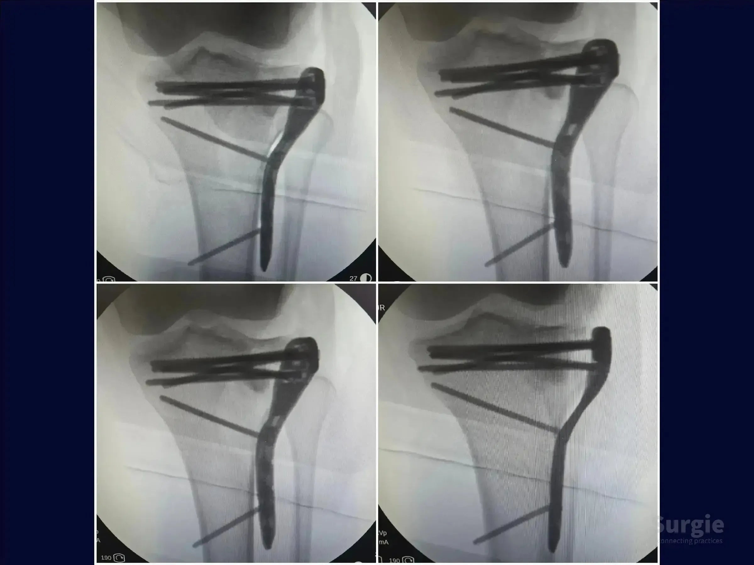 X-ray showing a tibial plateau fracture stabilized with a metal plate and screws after an incomplete osteotomy.