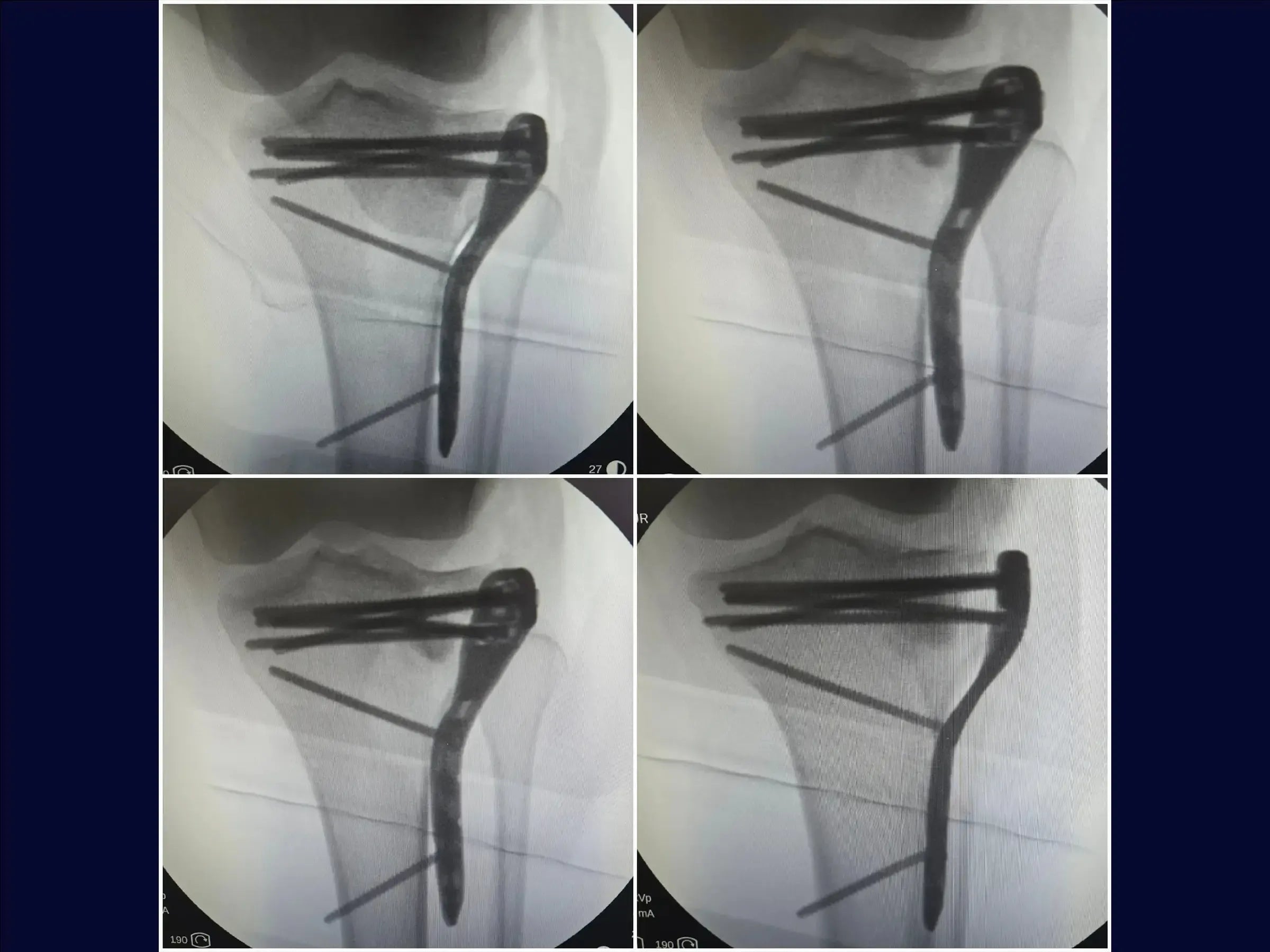 Tibiakopffraktur mit zentraler Depression und inkompletter Osteotomie