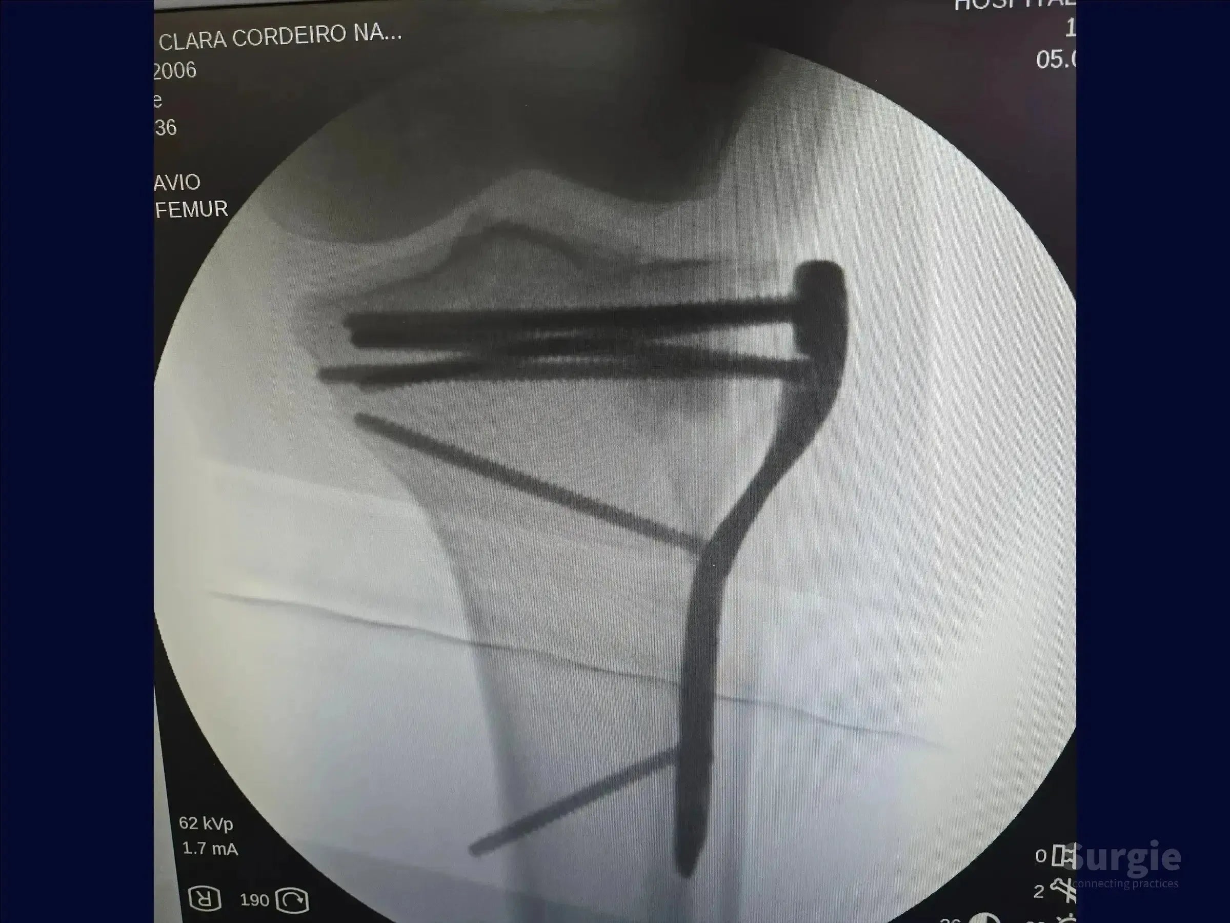 X-ray showing a tibial plateau fracture stabilized with a metal plate and multiple screws for anatomical reduction.