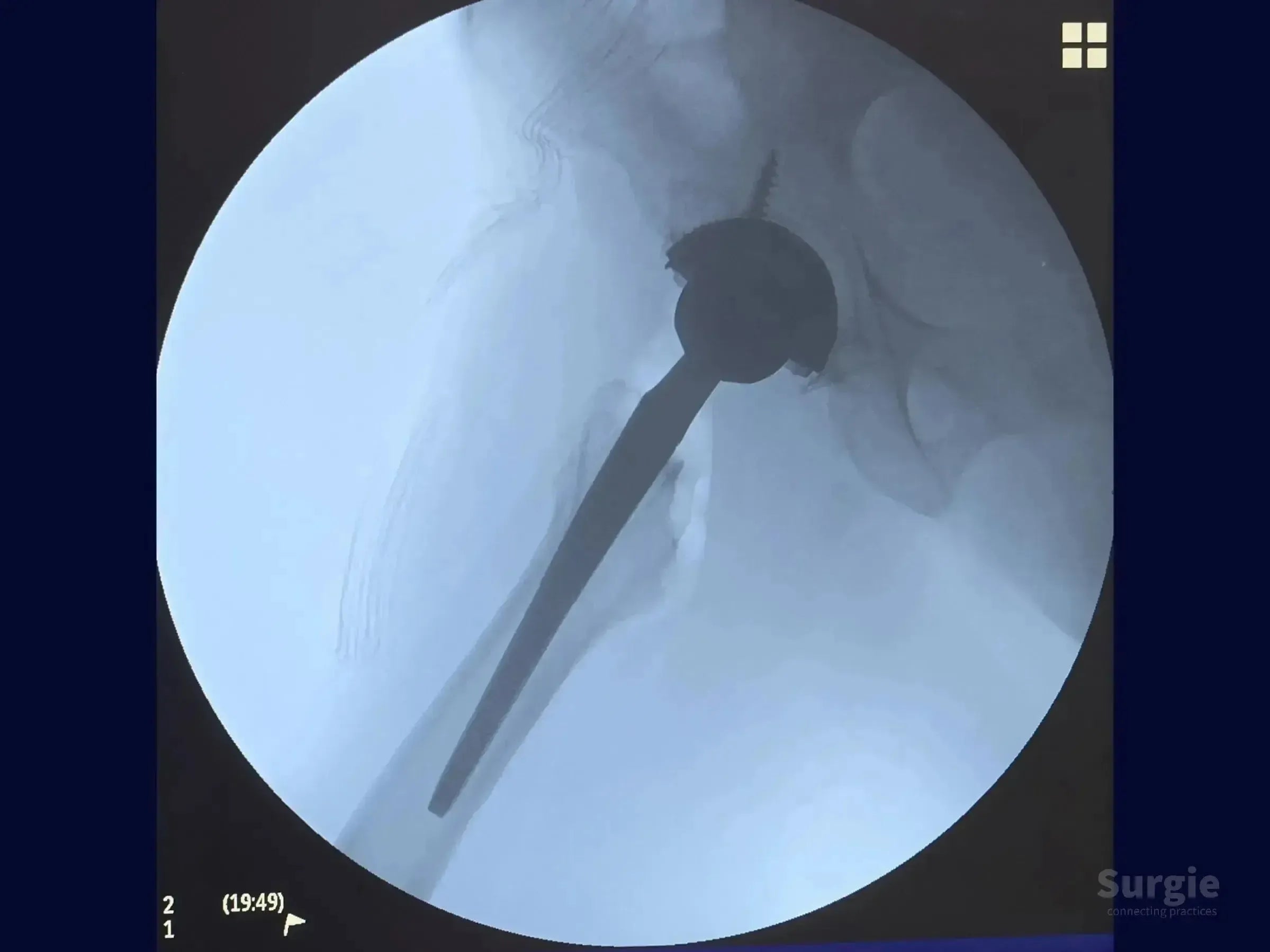 Fluoroscopic view of a total hip arthroplasty showing an uncemented femoral stem and acetabular cup with screw fixation.