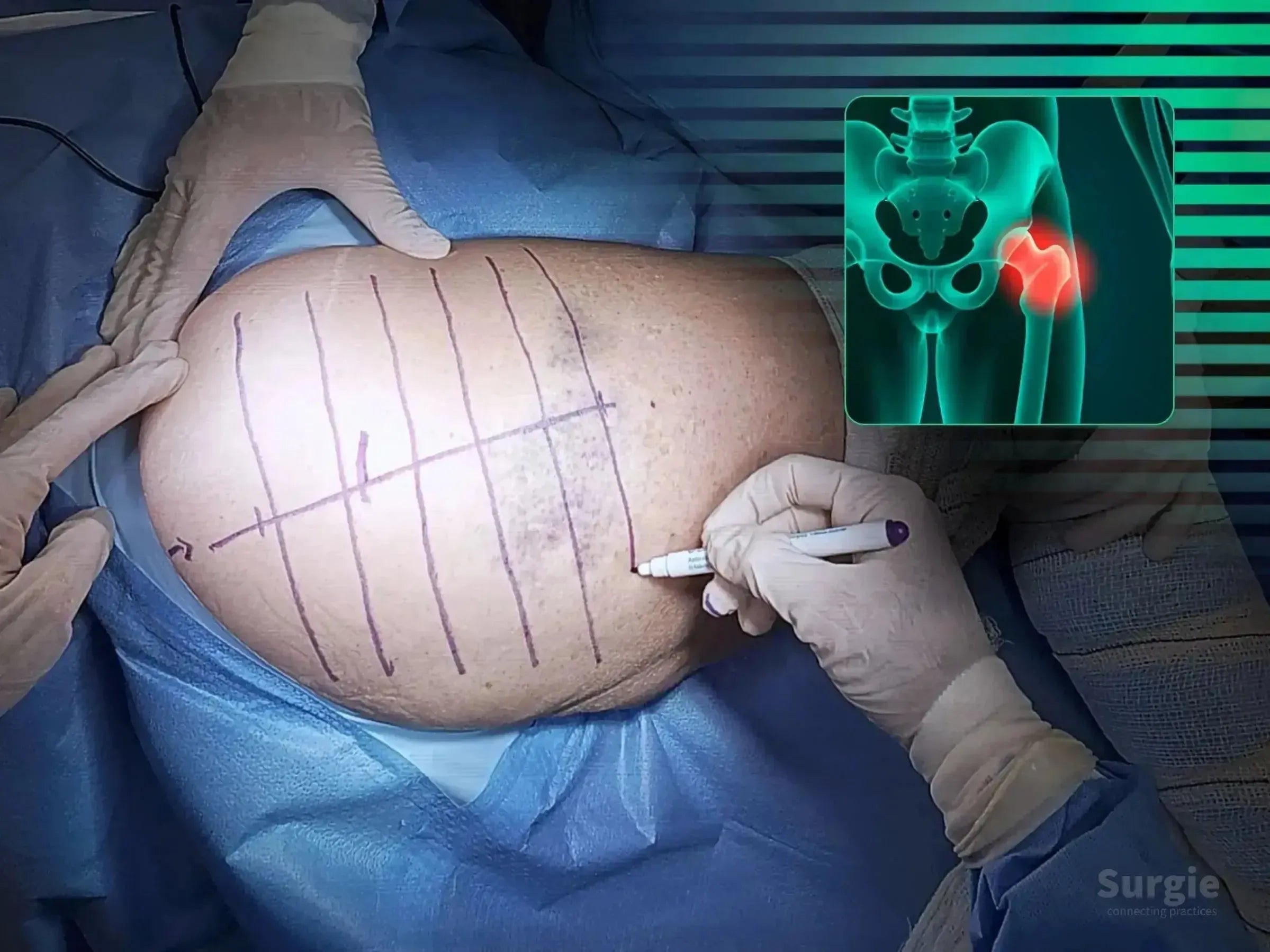 Surgeon marking a patient's hip for posterior approach surgery with an anatomical hip joint overlay.