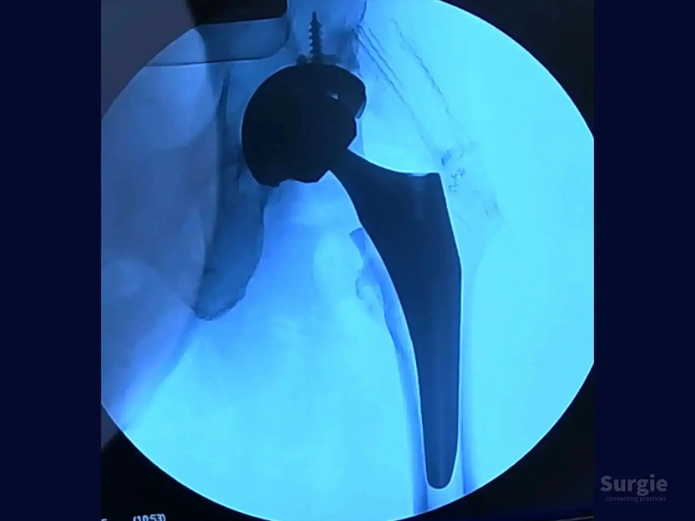 Fluoroscopic X-ray showing a hip prosthesis implant with a metal femoral stem and acetabular cup in the pelvic cavity.