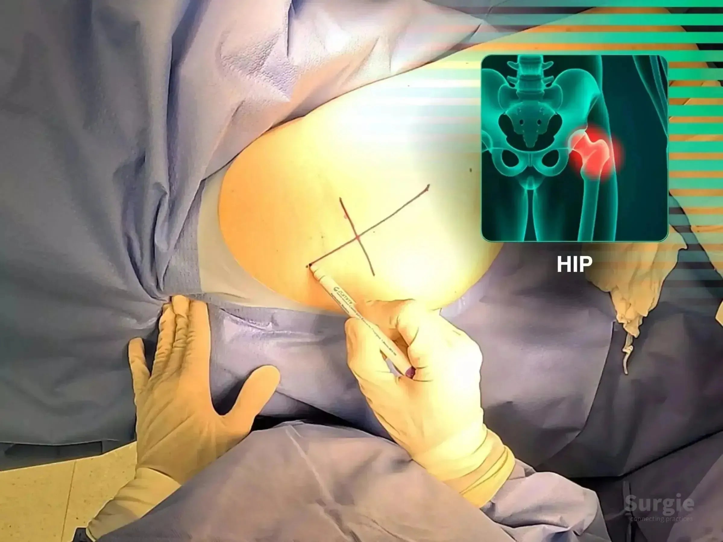 Surgeon marking a hip incision site with an anatomical overlay showing a femoral neck fracture for THA planning.