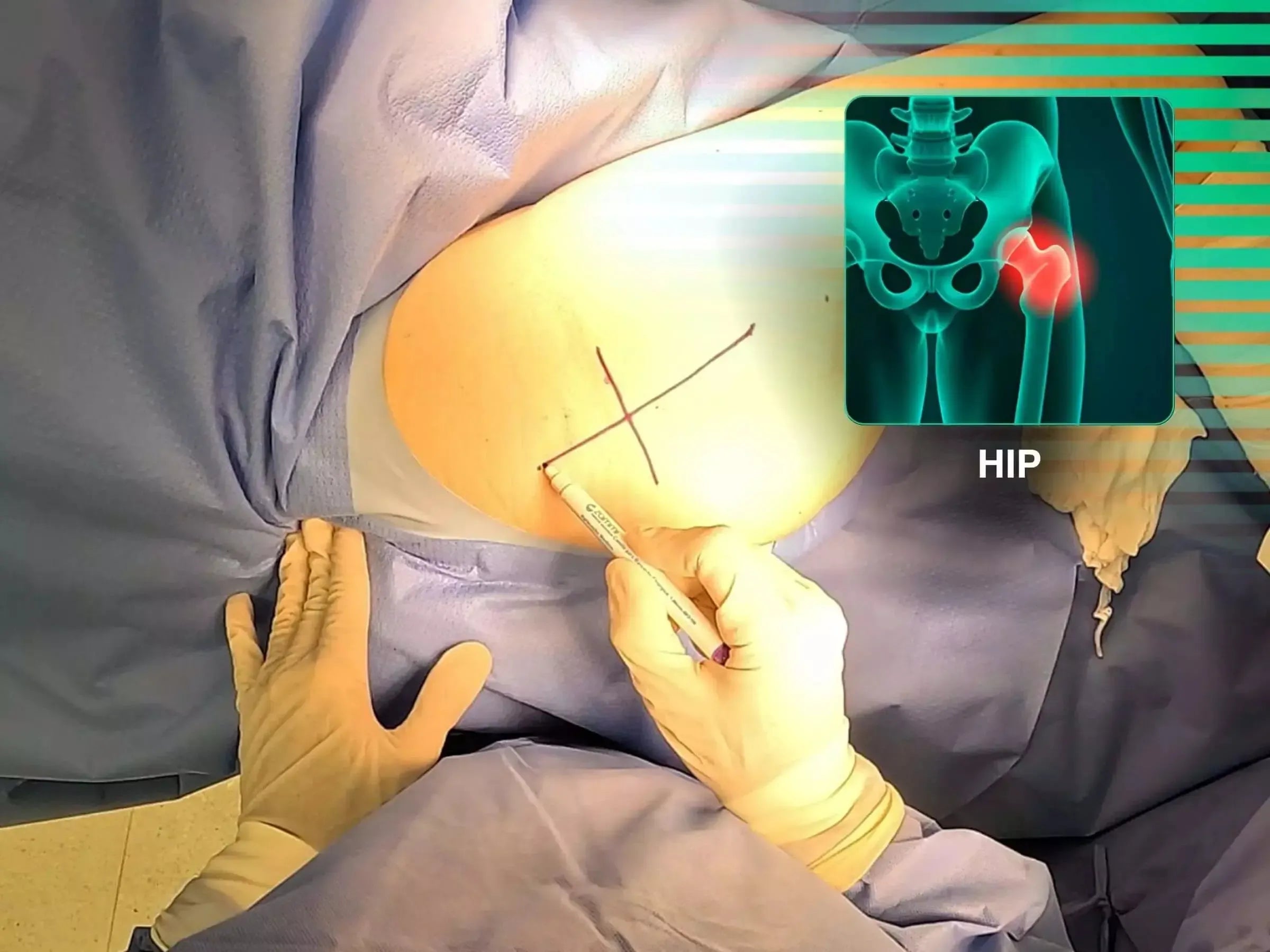 Total Hip Arthroplasty (THA) for Femoral Neck Fracture (Posterior Approach)