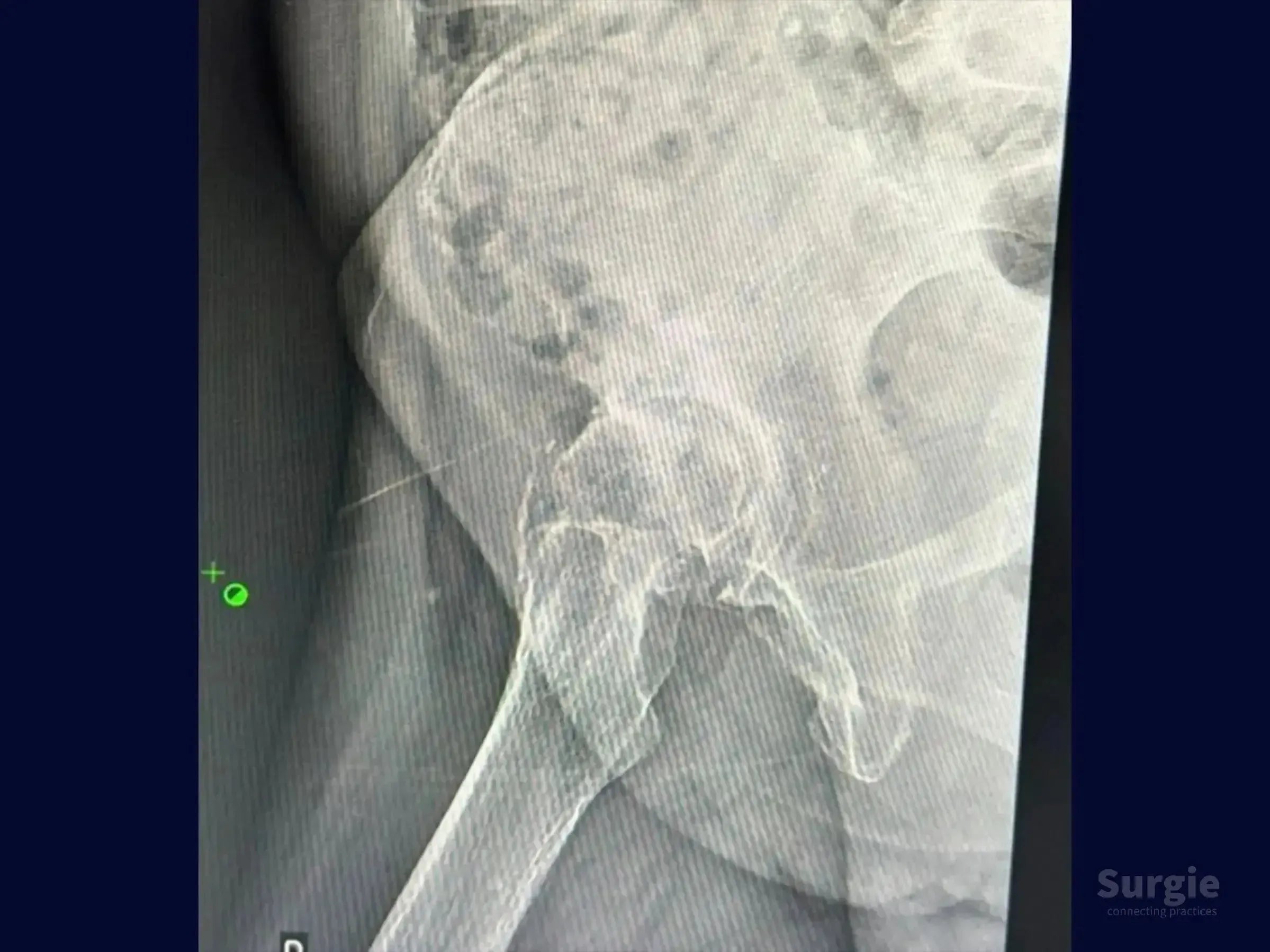 Grayscale X-ray showing a hip joint with coxarthrosis, displaying narrowed joint space and bone density changes.
