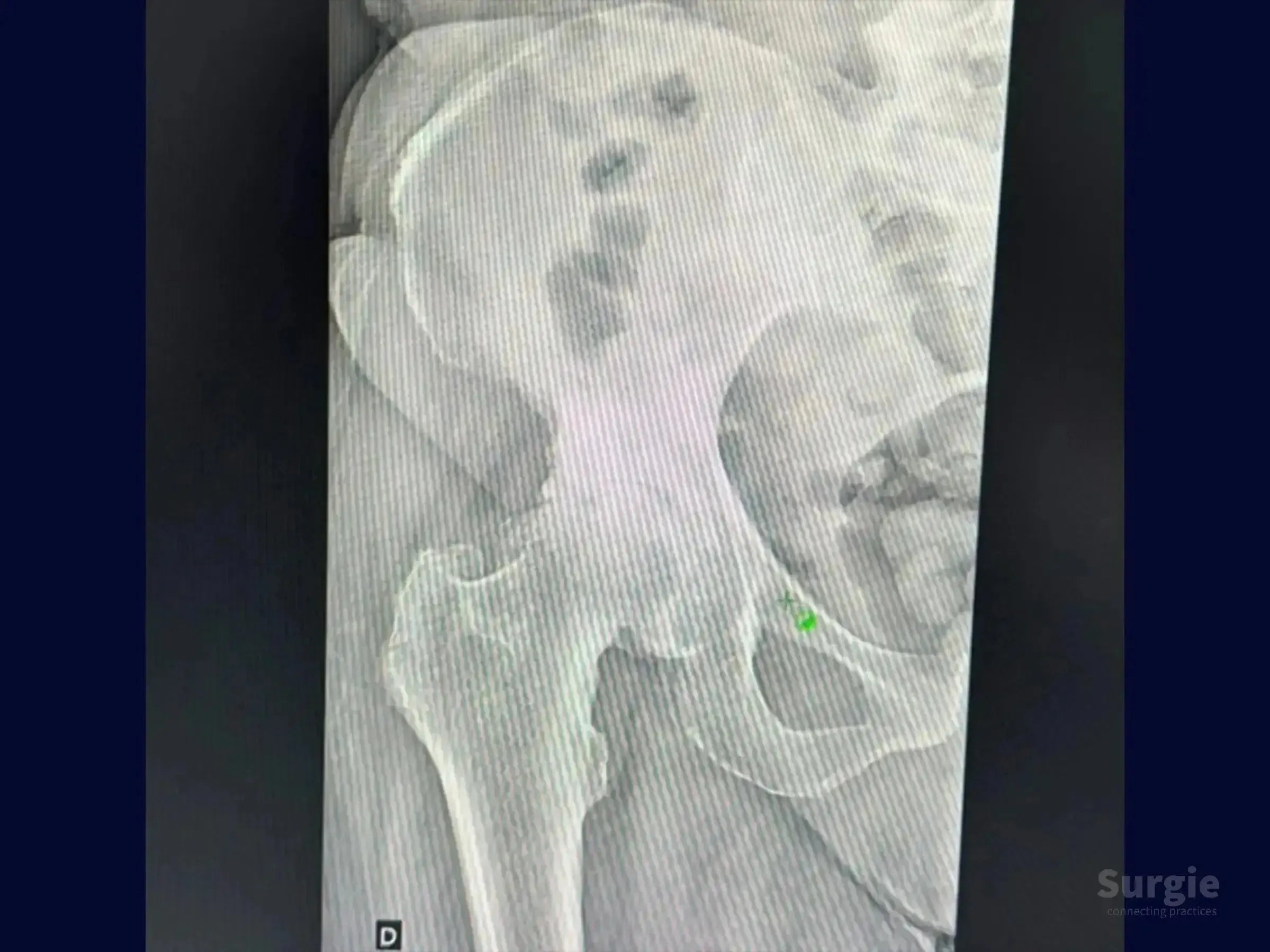 Grayscale pelvic X-ray showing the hip joint and femur for total hip arthroplasty planning.