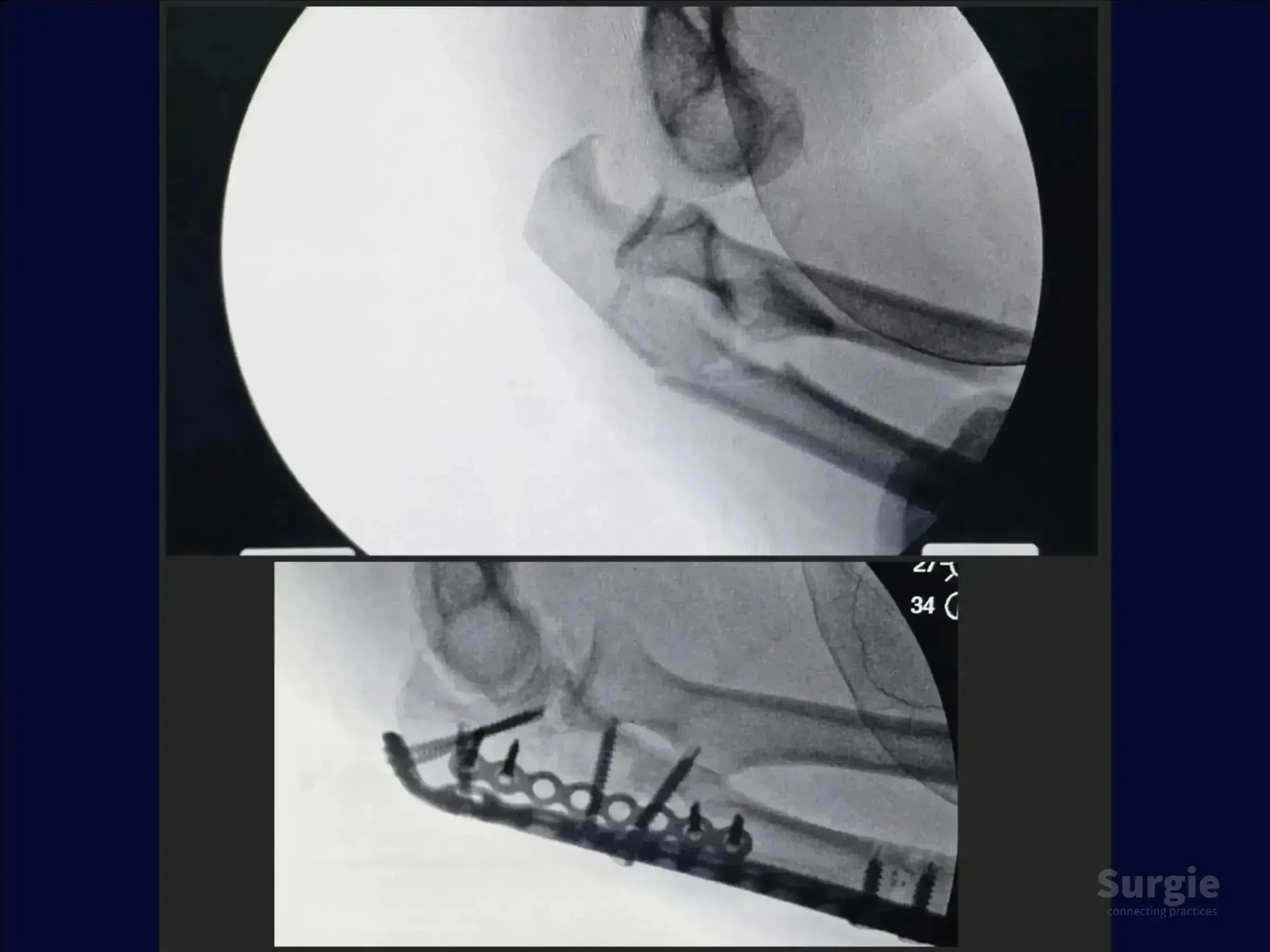 X-ray showing pre-operative transolecranon fracture-dislocation and post-operative fixation with a metal plate and screws.
