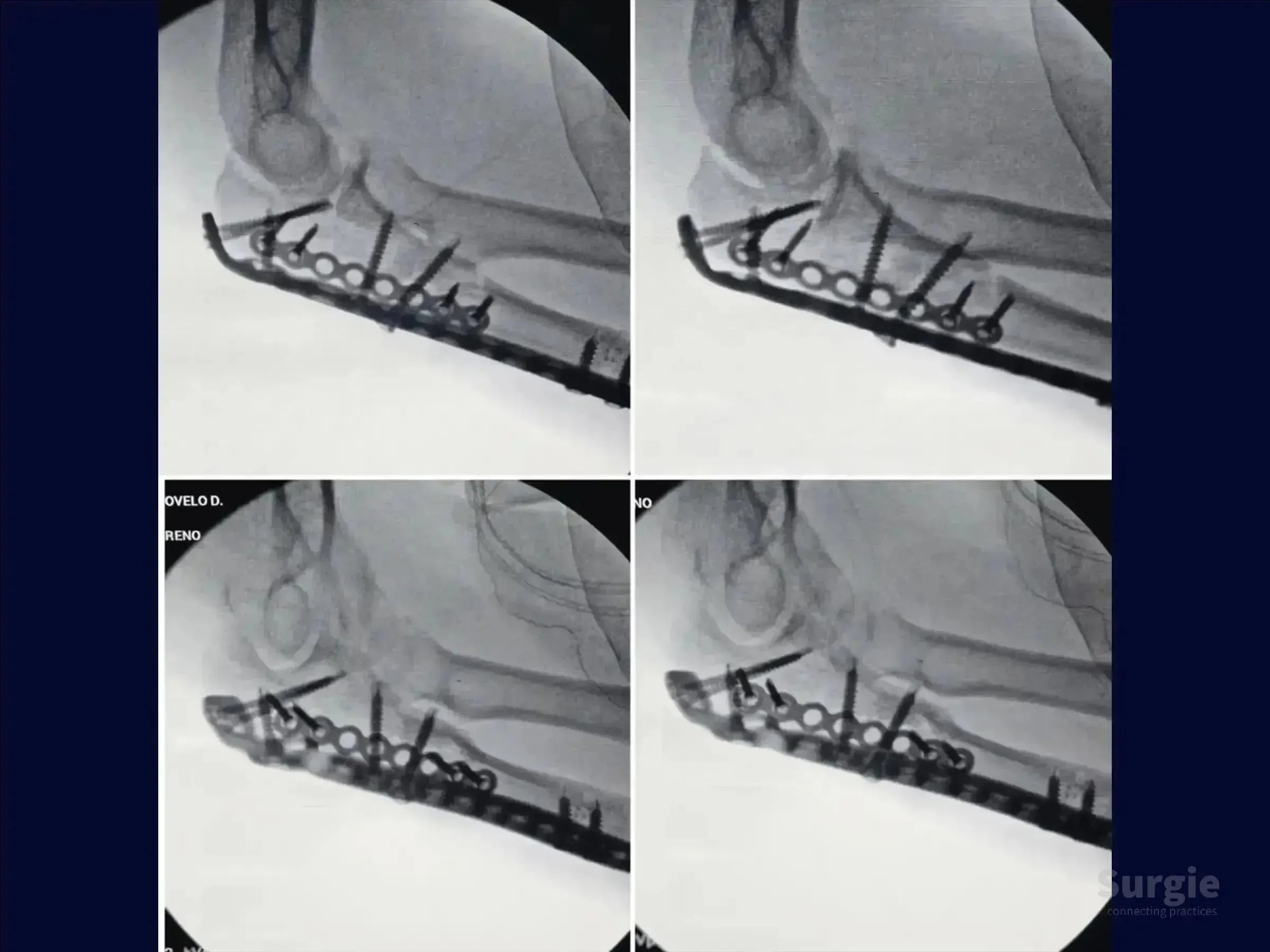 X-ray showing internal fixation of a transolecranon fracture with a metal plate and screws in the proximal ulna.